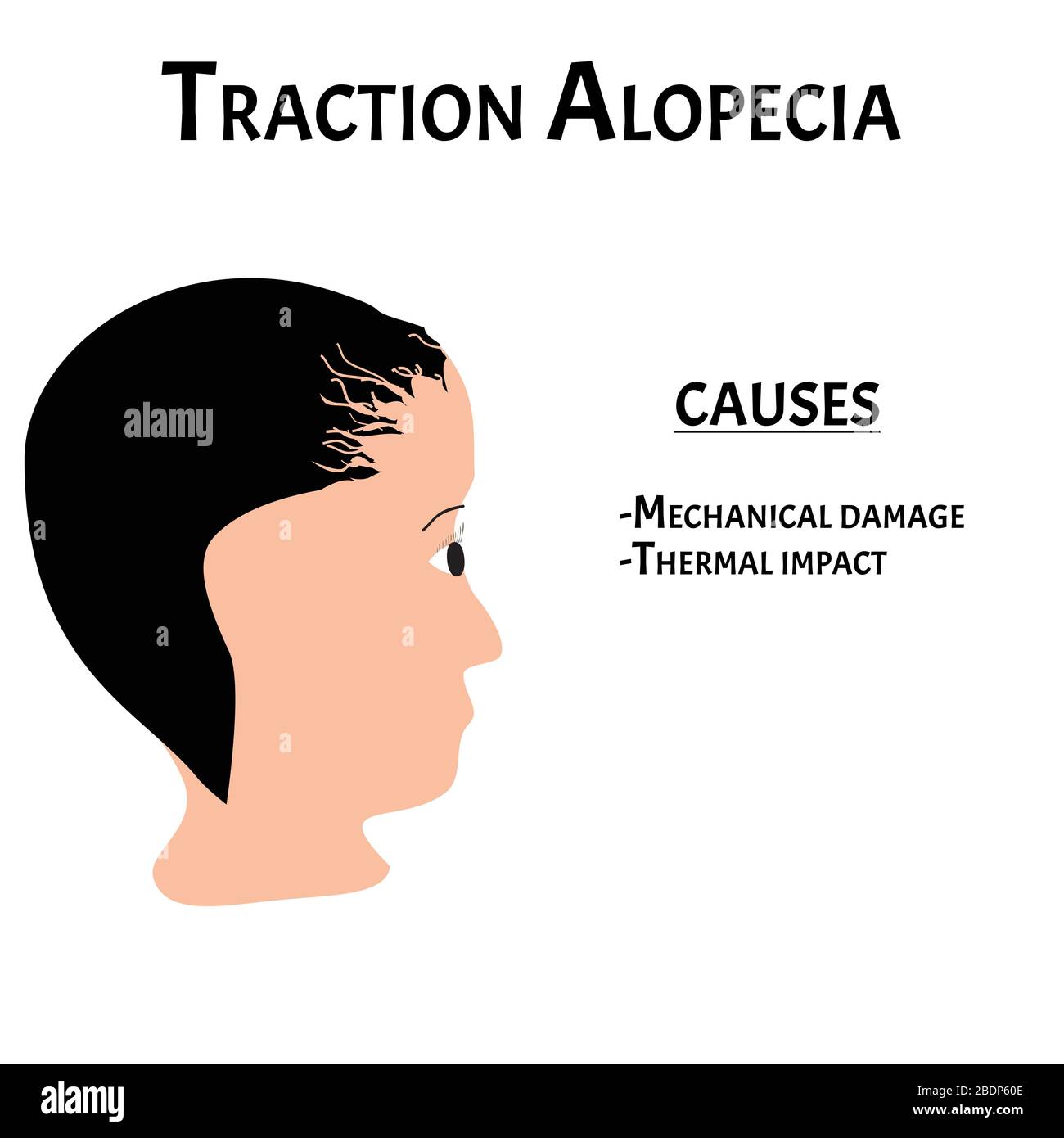 Alopezie Haar. Haarausfall am Kopf. Ursachen für Traktionsalopezie. Infografiken. Vektordarstellung auf isoliertem Hintergrund. Stock Vektor