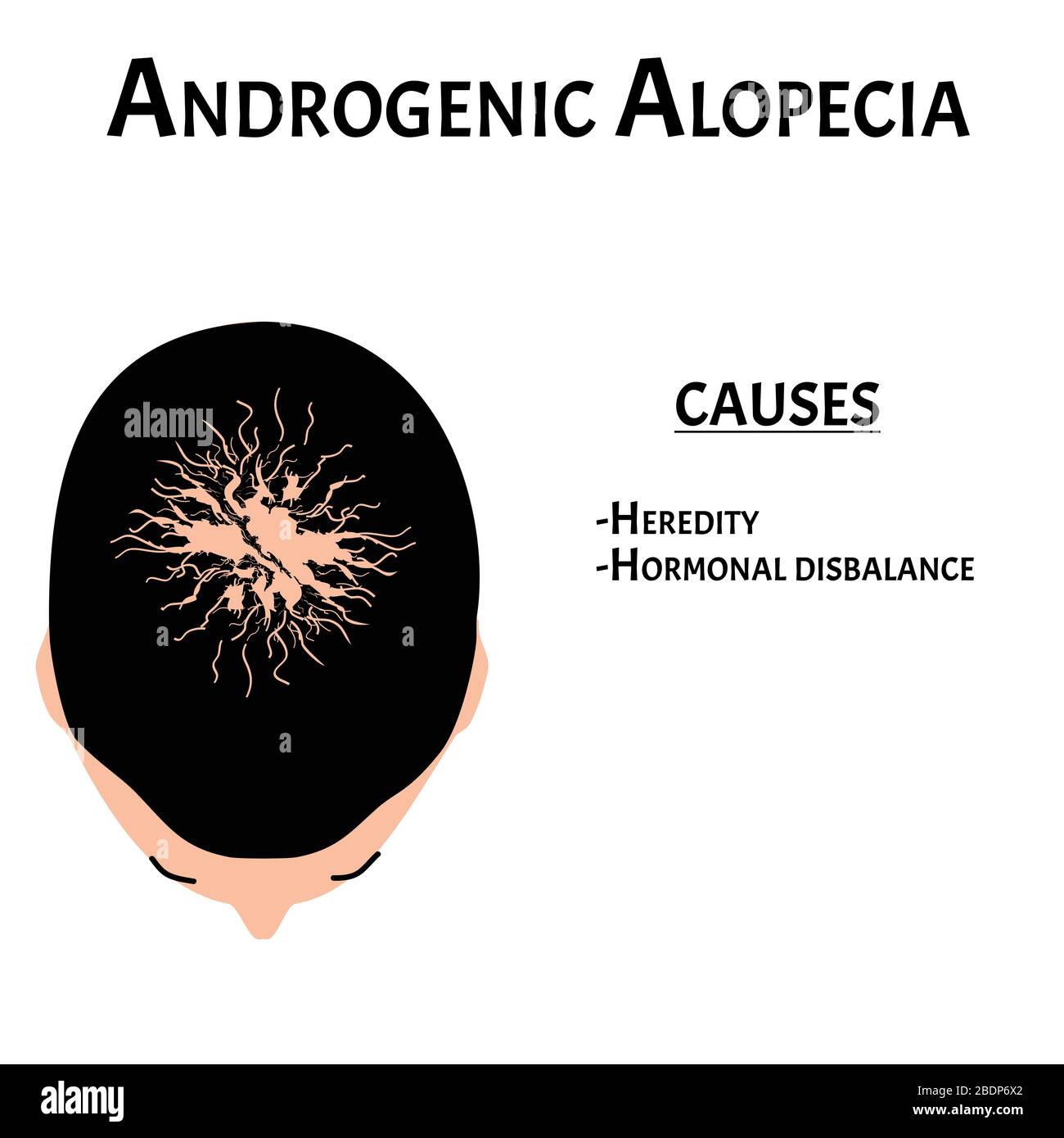 Alopezie Haar. Haarausfall am Kopf. Androgene Alopezie verursacht. Infografiken. Vektordarstellung auf isoliertem Hintergrund. Stock Vektor