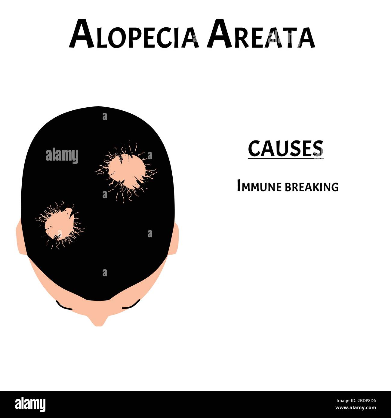 Alopezie Haar. Haarausfall am Kopf. Alopecia areata verursacht. Infografiken. Vektordarstellung auf isoliertem Hintergrund. Stock Vektor