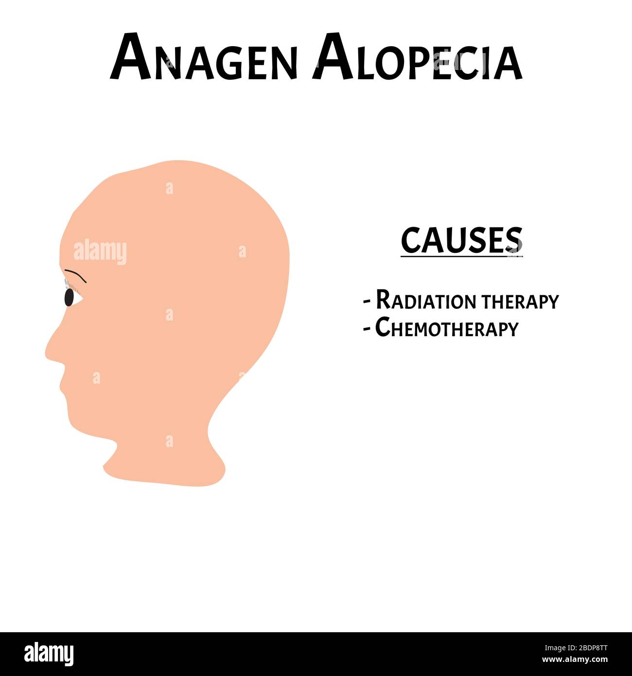 Alopezie Haar. Haarausfall am Kopf. Alagen Alopecia verursacht. Infografiken. Vektordarstellung auf isoliertem Hintergrund. Stock Vektor