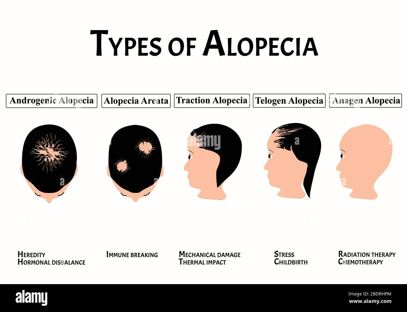 Arten von Alopezie. Glatze, Kahlheit, Alopecia Mesotherapie. Ursachen für Kahlheit. Infografiken. Vektordarstellung auf isoliertem Hintergrund. Stock Vektor