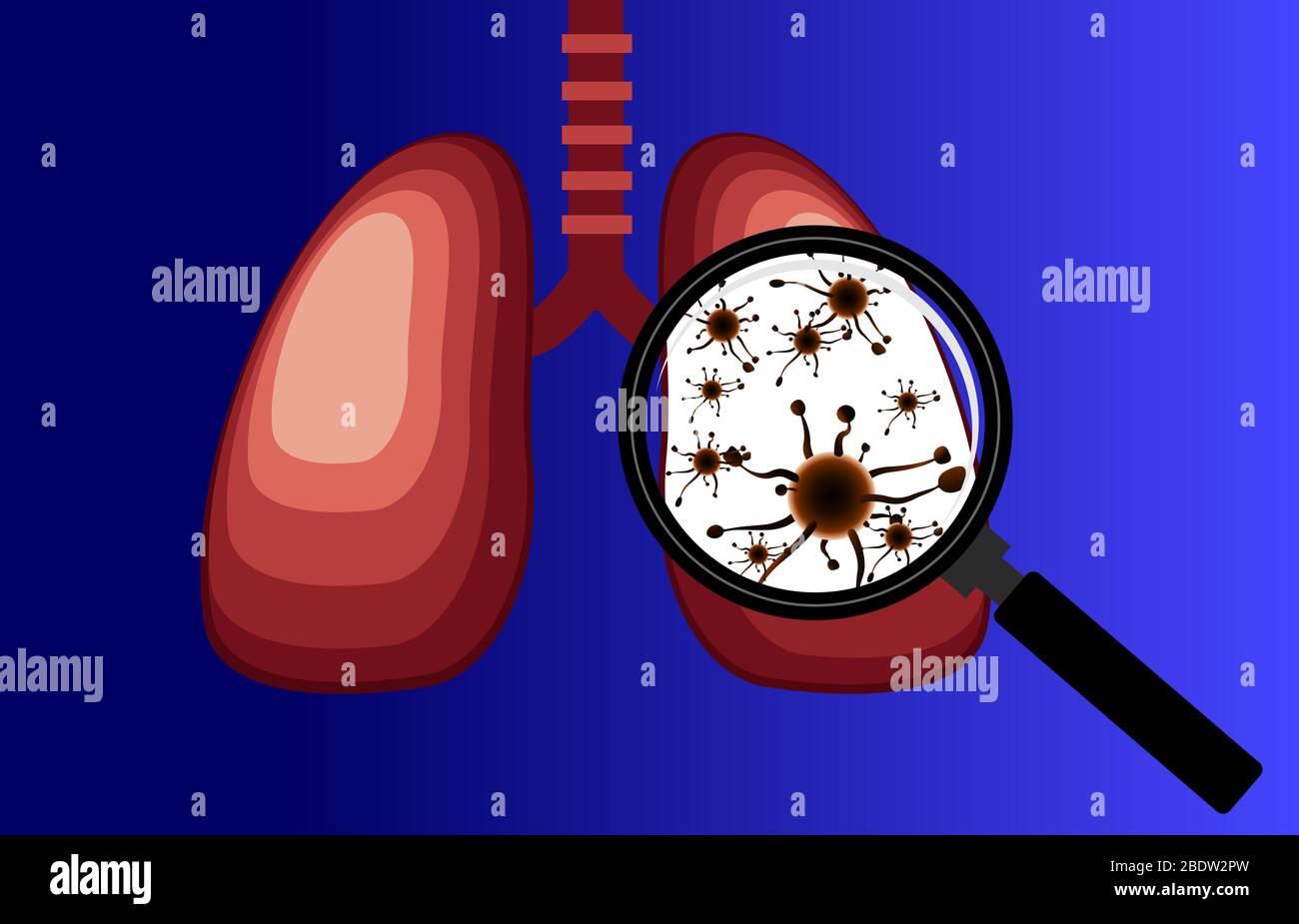 Virus und Bakterien infiziert die menschliche Lunge. Lungenerkrankung, Lupe erkennt Lungenvirus, isoliert blauen Hintergrund - Vector Stockfoto
