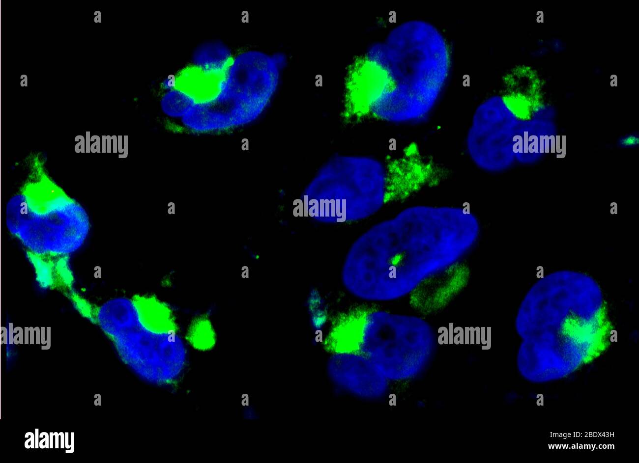 Nanopartikel in Gliom Zellkernen Stockfoto