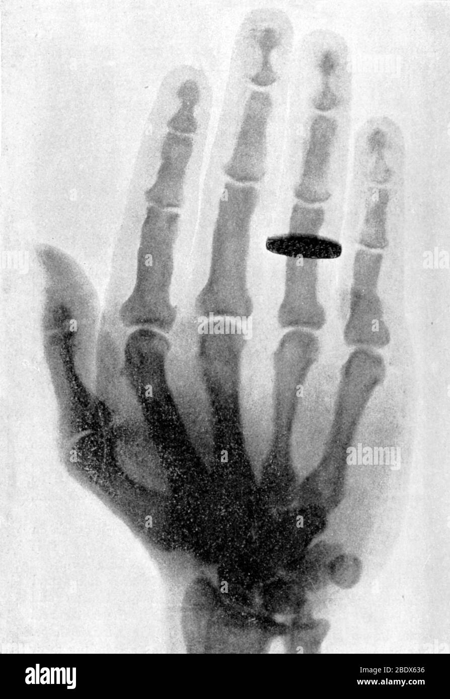 Akromegaly Röntgen, 1899 Stockfoto