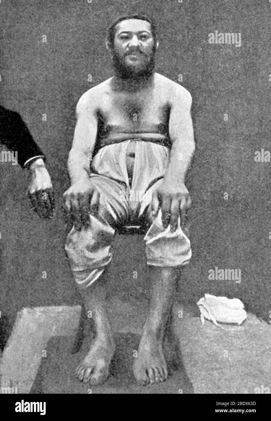 Akromegalie, 1899 Stockfoto