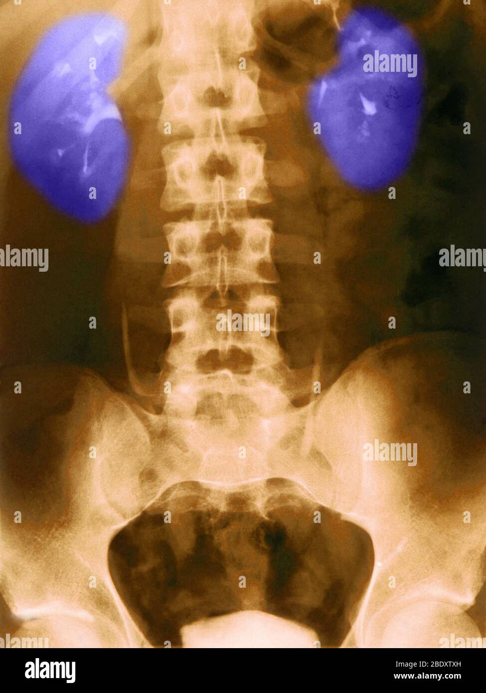 Röntgen der Nieren Normal Stockfoto