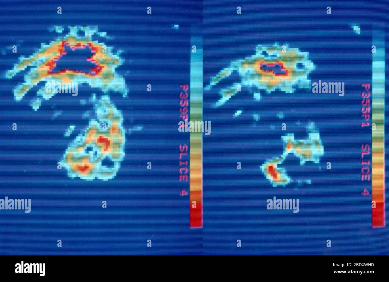 PET-Scans des menschlichen Herzens mit Blutfleck Stockfoto