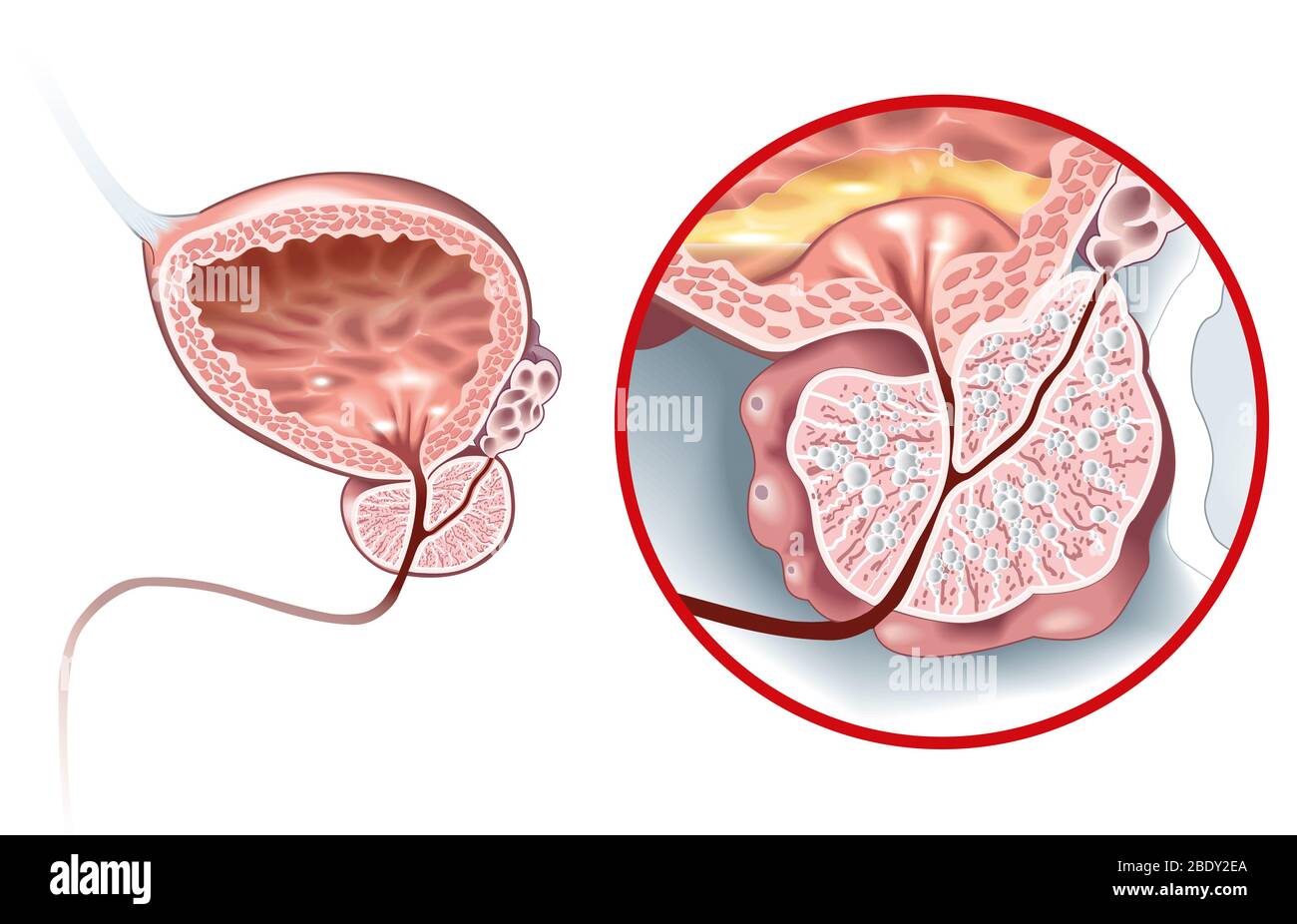 Abbildung zeigt gesunde Prostata und gutartige Prostatahyperplasie (BPH), vergrößerte Prostata mit Blase, Harnröhre und Samenbläschen Stockfoto
