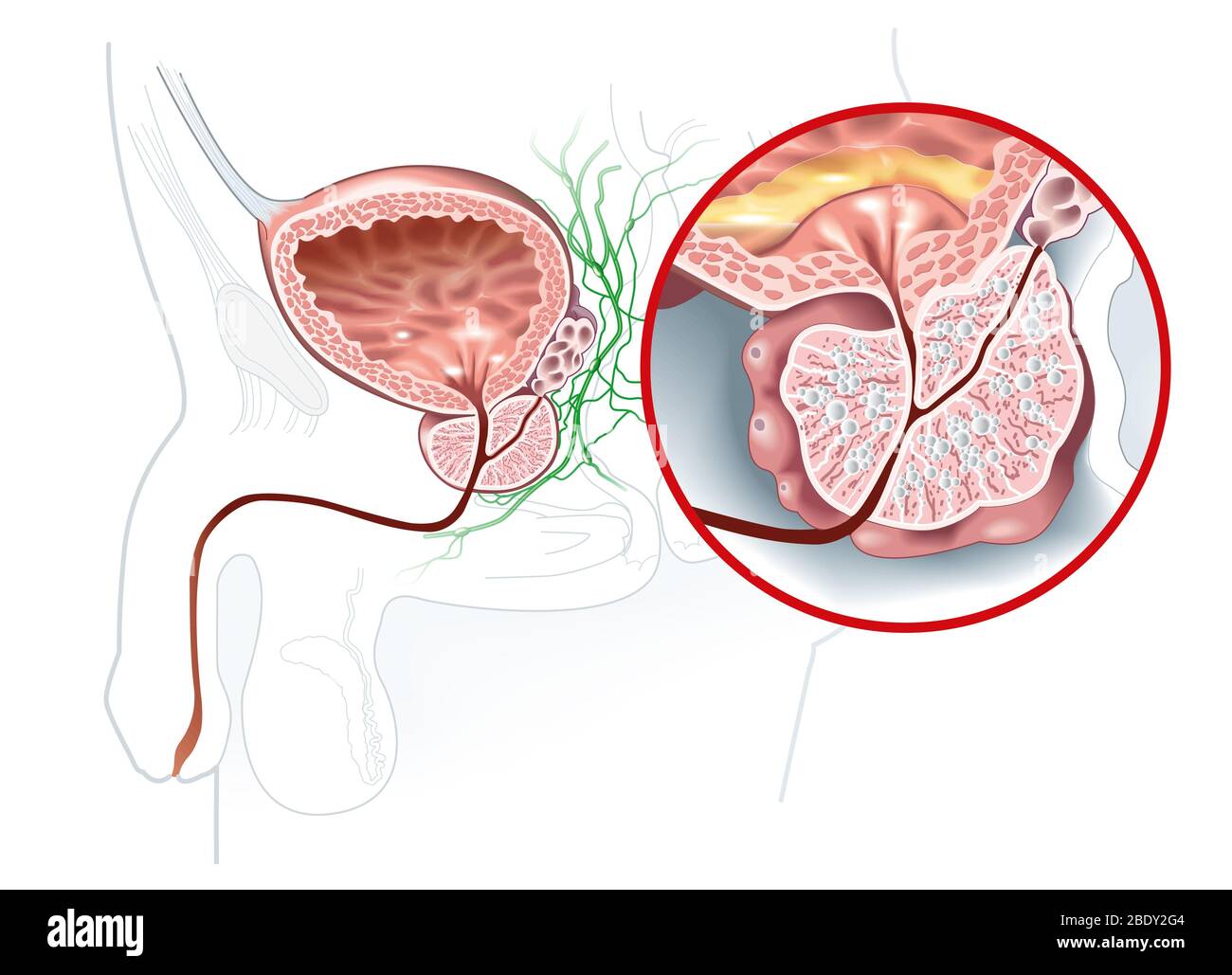 Vergrosserte Prostata Stockfotos Und Bilder Kaufen Alamy