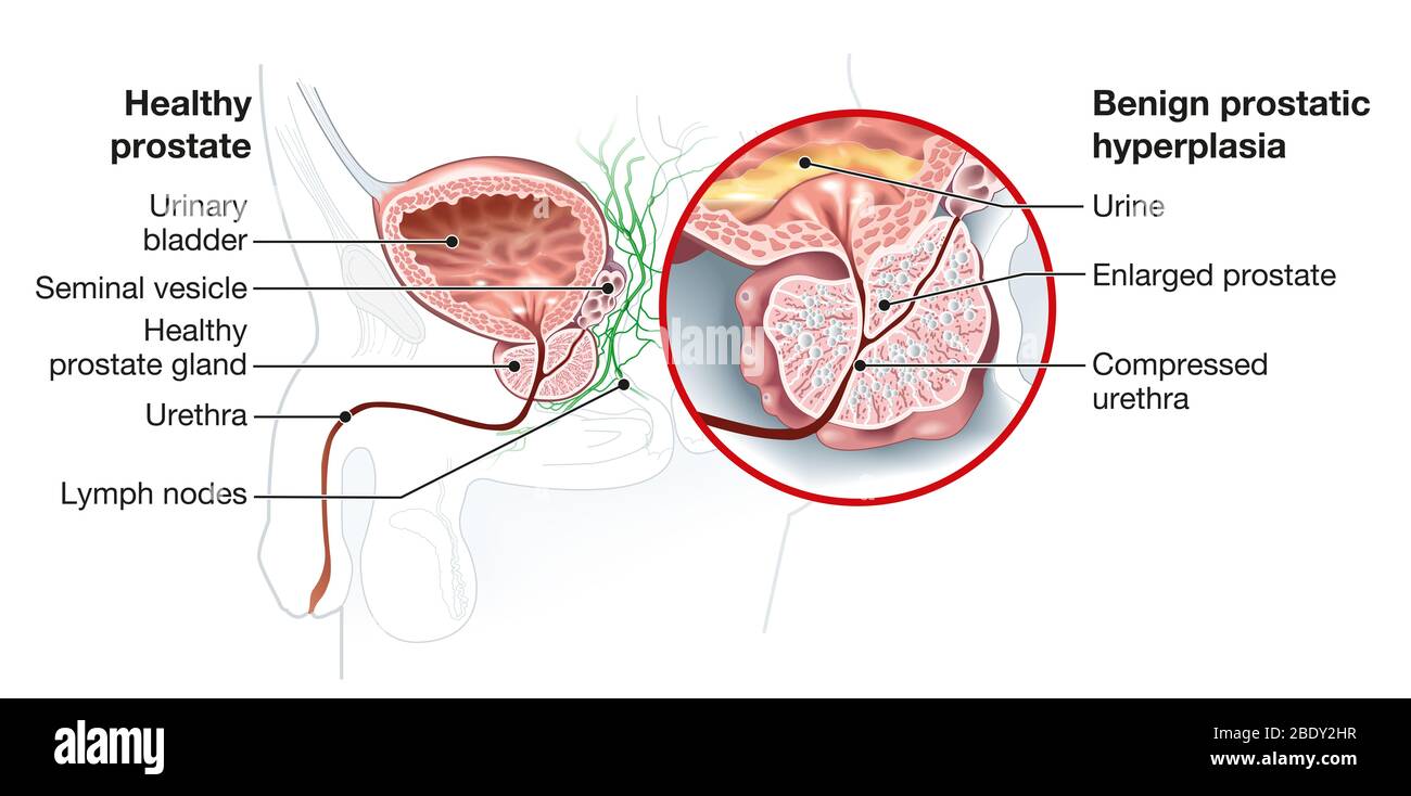 Abbildung zeigt gesunde Prostata und gutartige Prostatahyperplasie (BPH), vergrößerte Prostata mit Blase, Harnröhre und Samenbläschen Stockfoto