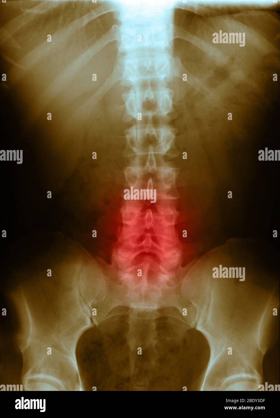 Kompression in Lendenwirbeln Stockfoto