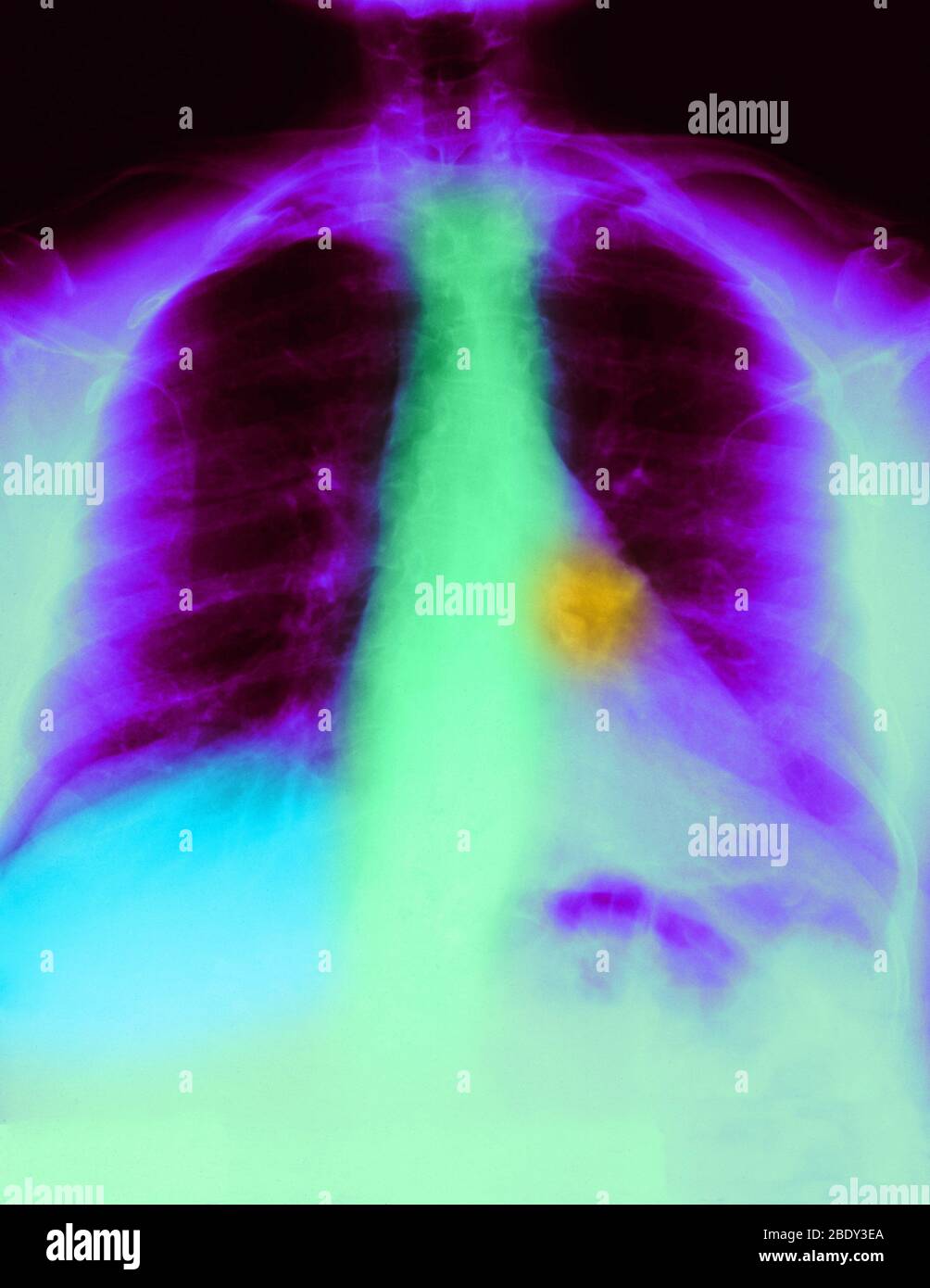 X-ray verkalkte Hilar Lymphknoten Stockfoto