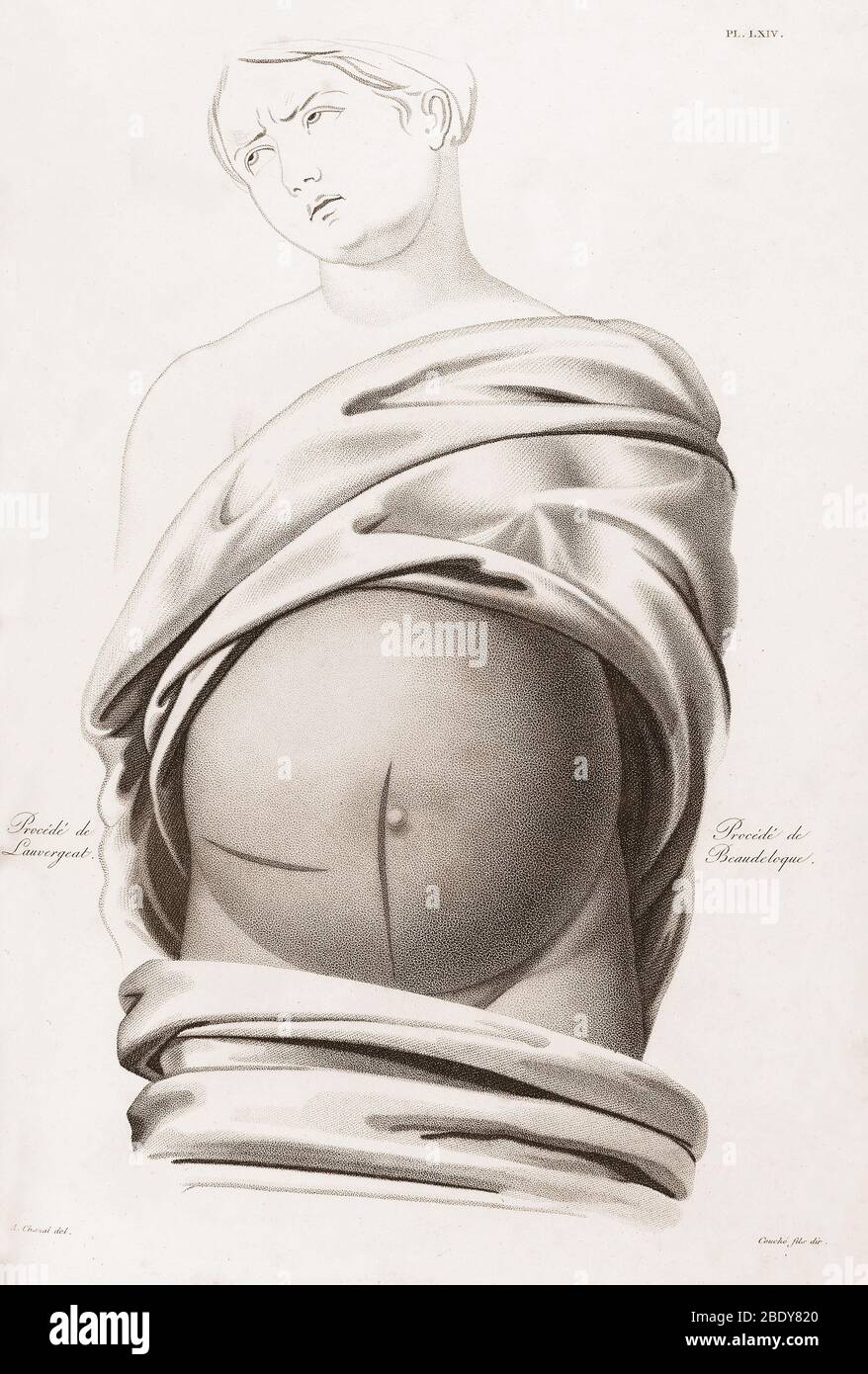 Kaiserschnitt, Schnitte, Illustration, 1822 Stockfoto