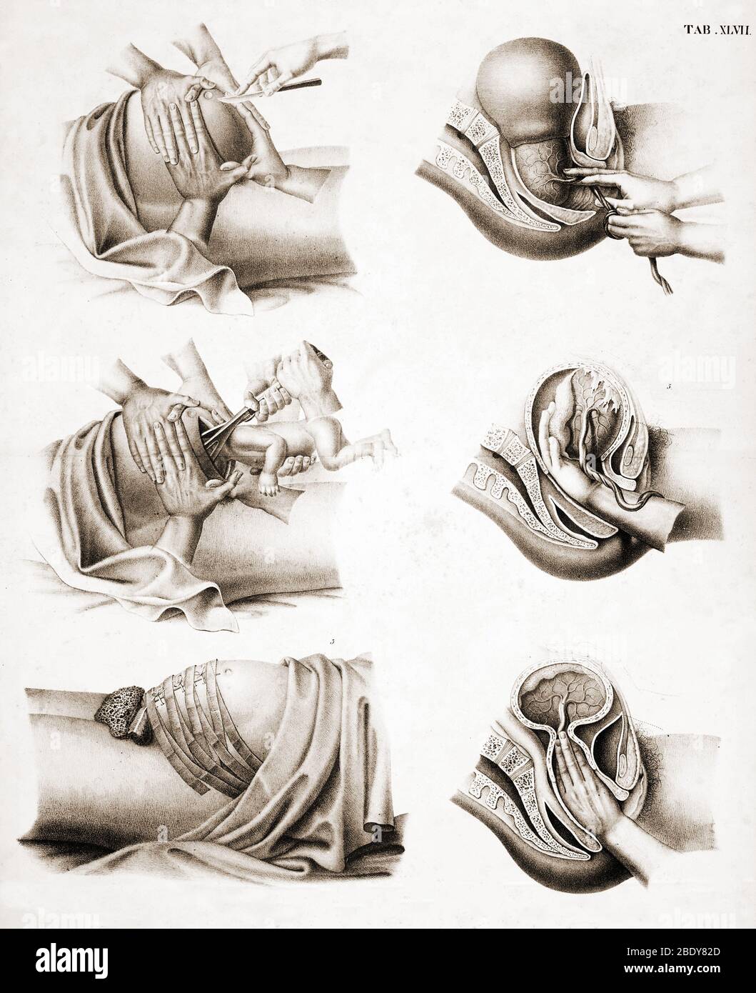 Geburt, Kaiserschnitt, 19. Jahrhundert Stockfoto