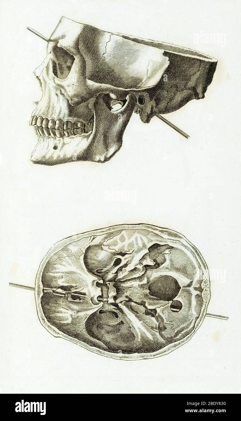 Schädel mit Kopfwunde, 1829 Stockfoto