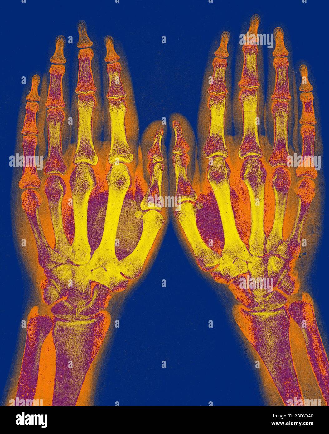 Röntgenbild zweier normaler Hände, 1896 Stockfoto