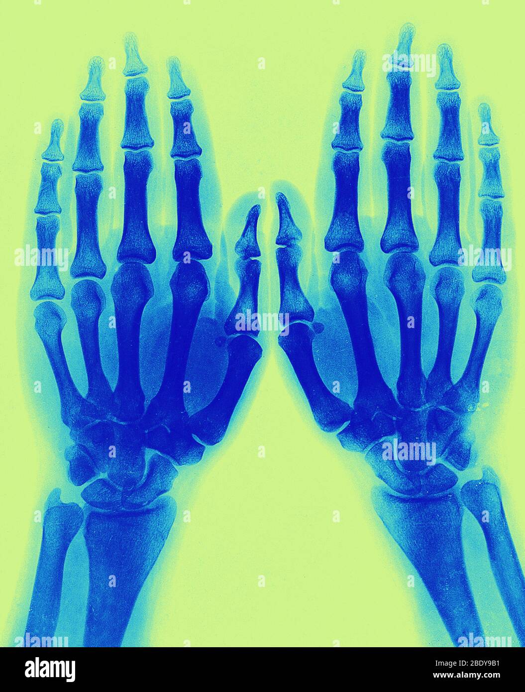 Röntgenbild zweier normaler Hände, 1896 Stockfoto