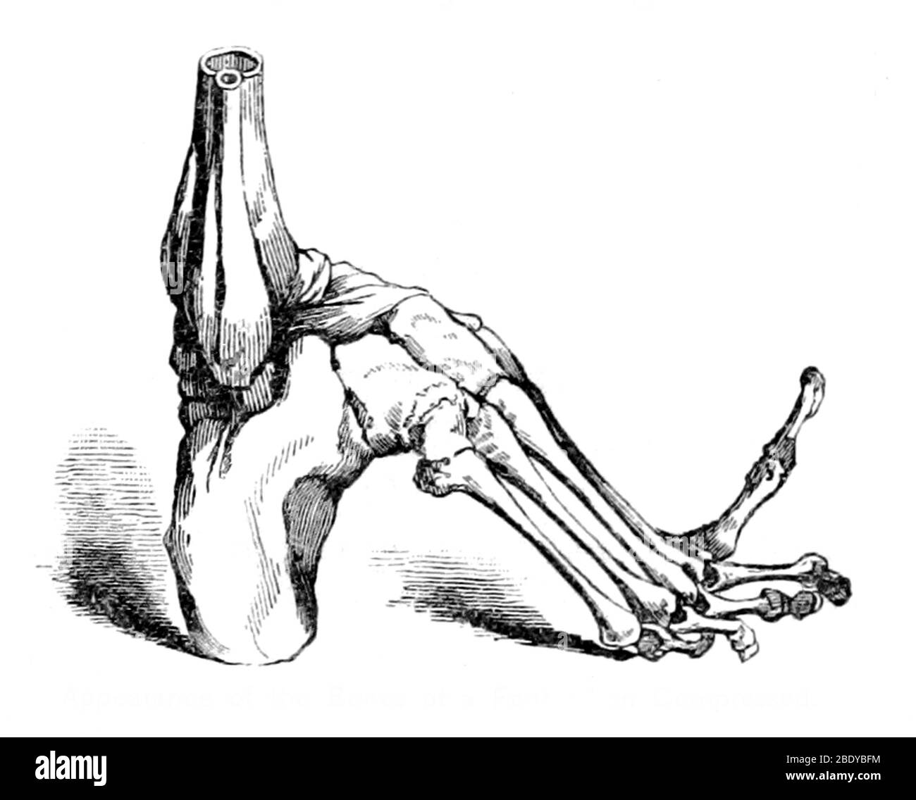 Knochen durch Fußbindung verkümmert, China, 1883 Stockfoto