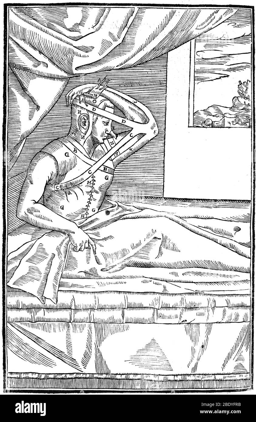 Tagliacozzi, wachsende Nase aus der Armhaut, 16. C. Stockfoto