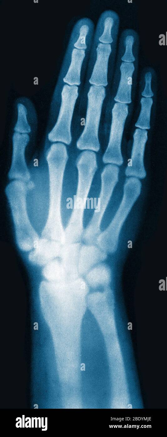 Röntgenbild der Hand der Frau, 1896 Stockfoto