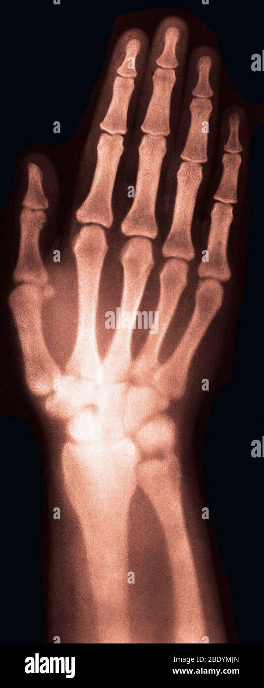 Röntgenbild der Hand der Frau, 1896 Stockfoto