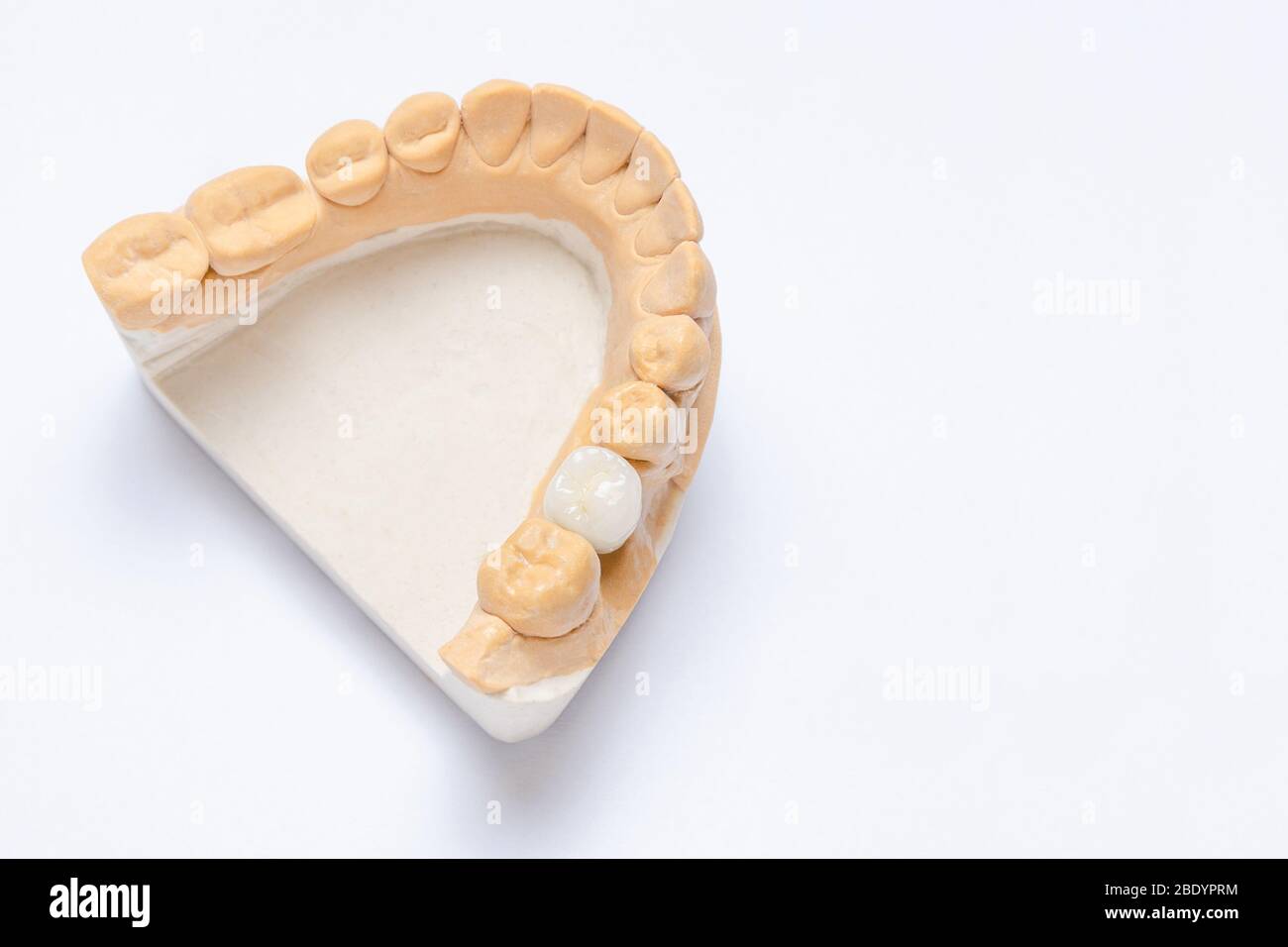 Auf weißem Hintergrund ist ein Gipsmodell des Unterkiefers mit einer keramischen Krone auf einem Zahnimplantat. Zahnprothetik Konzept. Krone machen Stockfoto