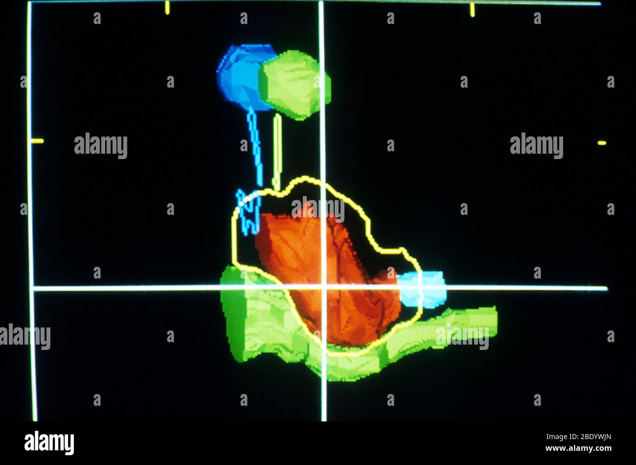 Protonenstrahl vom Gehirn während des CT-Scans Stockfoto