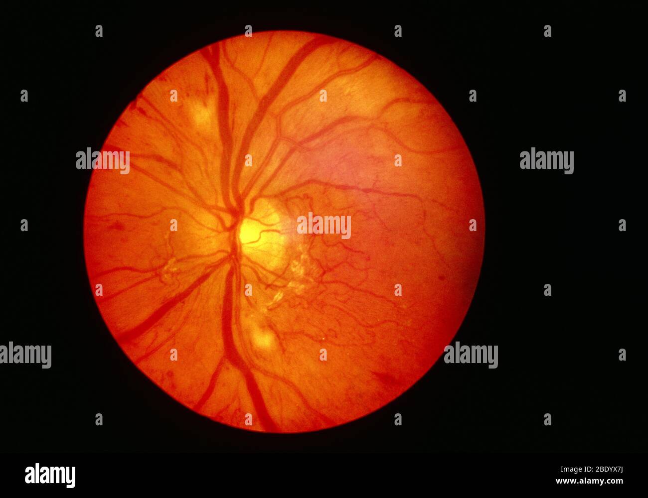 Opthalmoskop Bild von normaler Retina Stockfoto