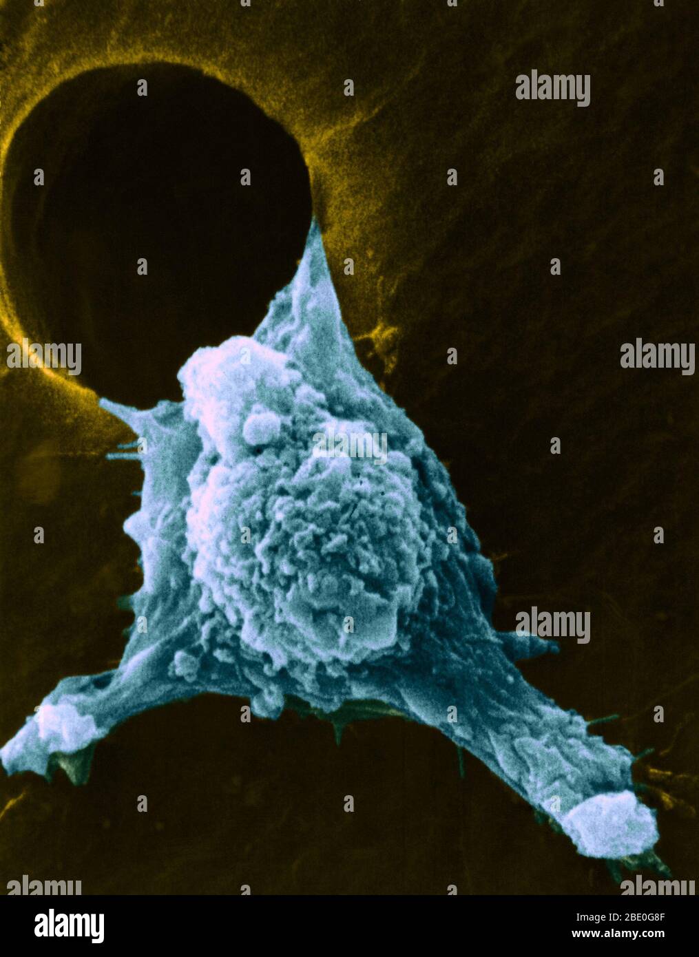 Migrierende Krebszelle. Farbige Rasterelektronenmikroskopie (SEM) einer kultivierten Krebszelle, die sich durch ein Loch in einem Stützfilm bewegt (metastasiert). Zahlreiche Pseudopodien (arm-ähnlich), Fillipodien (fadenähnlich) und Oberflächenblumpen (Klumpen) sind zu sehen. Diese Eigenschaften sind charakteristisch für hochmobile Zellen und ermöglichen Krebszellen, sich schnell um den Körper zu verbreiten und in andere Organe und Gewebe einzudringen (Metastasen). Stockfoto