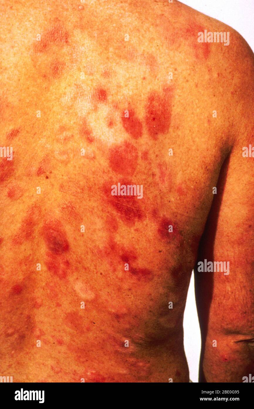 Kaposi-Sarkom nach Interferon-Behandlung. Stockfoto