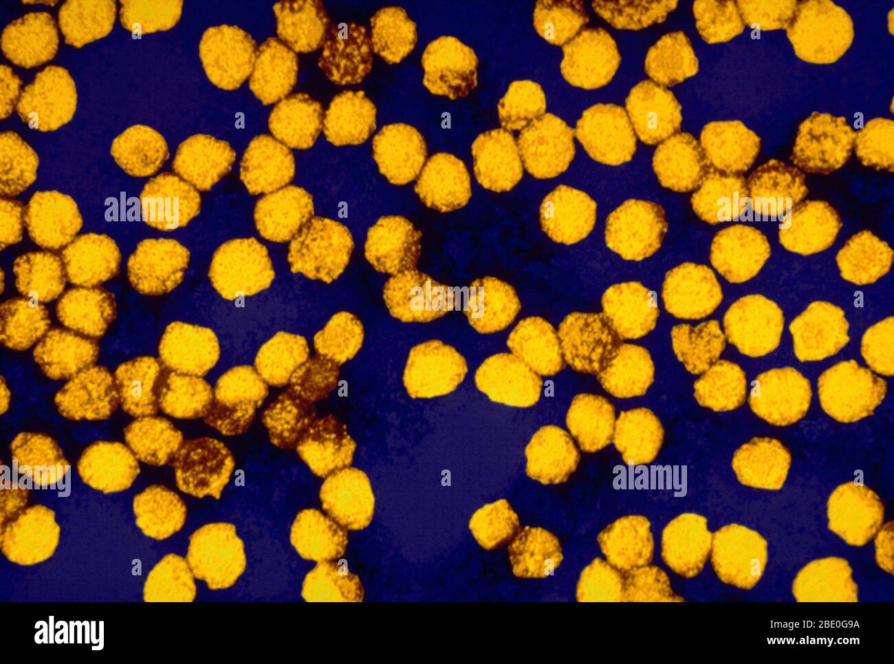Farblich verstärkter Transmission Electron Micrograph (TEM) von Gelbfieber-Virusvirionen. Gelbfieber wird durch das Gelbfiebervirus der Familie Flaviviridae verursacht. Es war die erste Krankheit, die durch gefiltertes menschliches Serum übertragbar und durch Mücken übertragen wurde, von Walter Reed um 1900. Die positiv-sense, Single-strängige RNA ist etwa 11,000 Nukleotide lang und hat einen einzigen offenen Leserahmen, der ein Polyprotein kodiert. Gelbfieber ist eine Viruserkrankung von typischerweise kurzer Dauer. In den meisten Fällen sind Symptome wie Fieber, Schüttelfrost, Appetitlosigkeit, Übelkeit, Muskelschmerzen, insbesondere im Bac Stockfoto