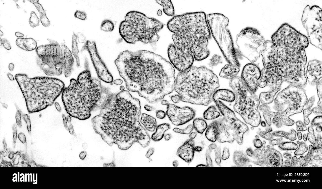 Transmission Electron Micrograph (TEM) zeigt eine Reihe von Nipah-Virus-Virionen, die aus einer Probe des Liquor (CSF) eines Patienten isoliert wurden. Nipah-Virus ist ein Mitglied der Familie Paramyxoviridae. Das Nipah-Virus wurde 1999 zunächst isoliert, nachdem Proben eines Ausbruchs von Enzephalitis und Atemwegserkrankungen bei erwachsenen Männern in Malaysia und Singapur untersucht wurden. Eine Infektion mit dem Nipah-Virus war mit einer Enzephalitis assoziiert, die durch Fieber und Schläfrigkeit und schwerwiegendere Erkrankungen des Zentralnervensystems wie Koma, Krampfanfälle und Atemnot gekennzeichnet war. Krankheit mit Stockfoto