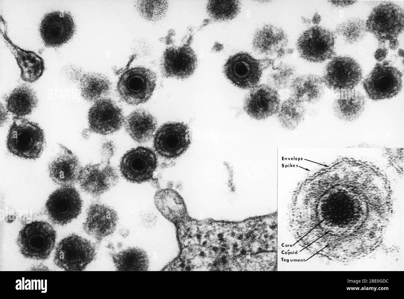 Das Foto eines Elektronenmikrographen von HHV-6 enthält auch einen markierten Einsatz des reifen Virus-Teilchens. Das HHV-6 ist ein doppelsträngiger DNA-Virus aus der Herpesfamilie. Die hier gezeigten Viruspartikel sind gereift und werden dann aus der angefallenen Lymphozyte freigesetzt. Das 'Eulenauge' der Viruspartikel ist charakteristisch für die Herpesfamilie. Das HHV-6 oder das menschliche Herpesvirus-6 wurde angenommen, dass es B-Zellen infizieren sollte und wurde zu einer Zeit als HBLV, menschliches b-lymphotropes Virus, bezeichnet. Es ist jetzt bekannt, T-Zellen zu infizieren und ist die Ursache für die Kindheit Ausschlag 'Roseola' und einige Fälle o Stockfoto