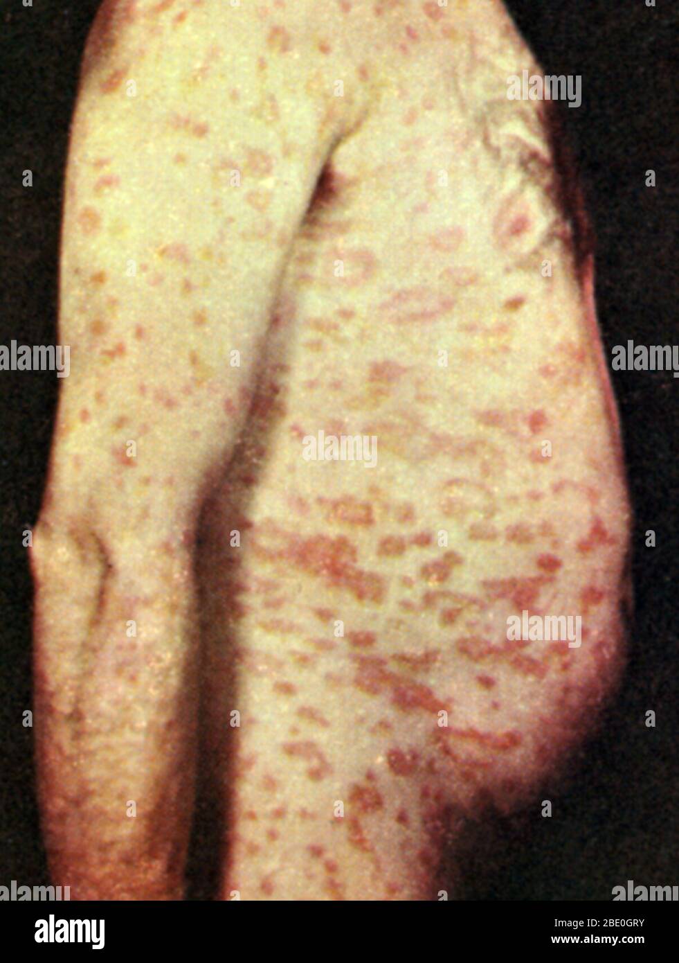 Pityriasis rosea, ein häufiger akuter und gutartiger Hautausschlag, der sich über den Körper ausbreitet und durch juckende Läsionen gekennzeichnet ist. Stockfoto