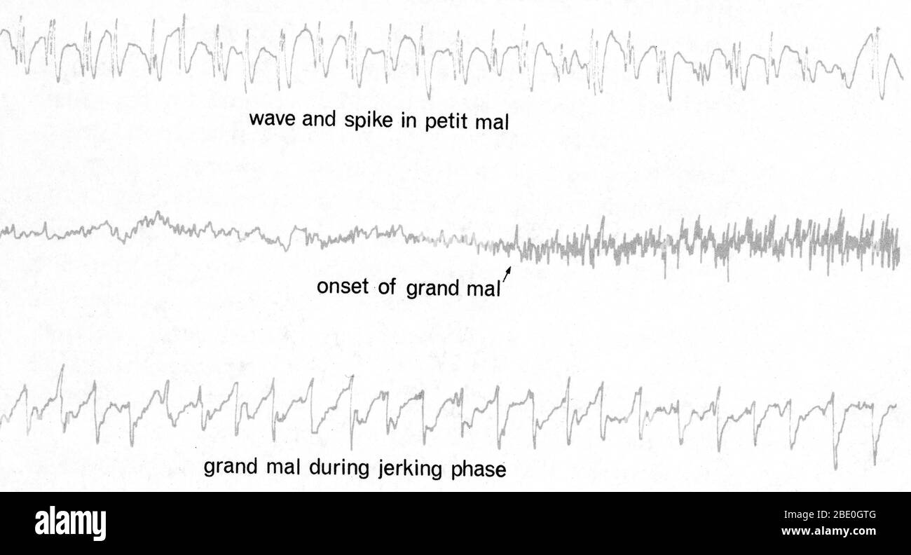 Die Anfälle der Epilepsie werden durch die EEG-Spuren dramatisch nachgewiesen. Die größte und regelmäßigste elektrische Aktivität des Gehirns tritt bei einem Angriff von "Petit mal" auf, obwohl der Patient nur für einige Sekunden leer bleibt. Die "Welle und Spitze" Schwankungen (oben), Explosionen der elektrischen Energie, kann fast das ganze Gehirn für eine Minute oder mehr beinhalten. Während der gefährlicheren und erschreckenden 'Grand mal', in dem der Patient auf den Boden fällt, das Bewusstsein verliert, steif geht und dann heftig zuckt, zeigen die Spuren bescheidene 8-pro-Sekunde-Wellen, die dann in Frequenz und steigen Stockfoto