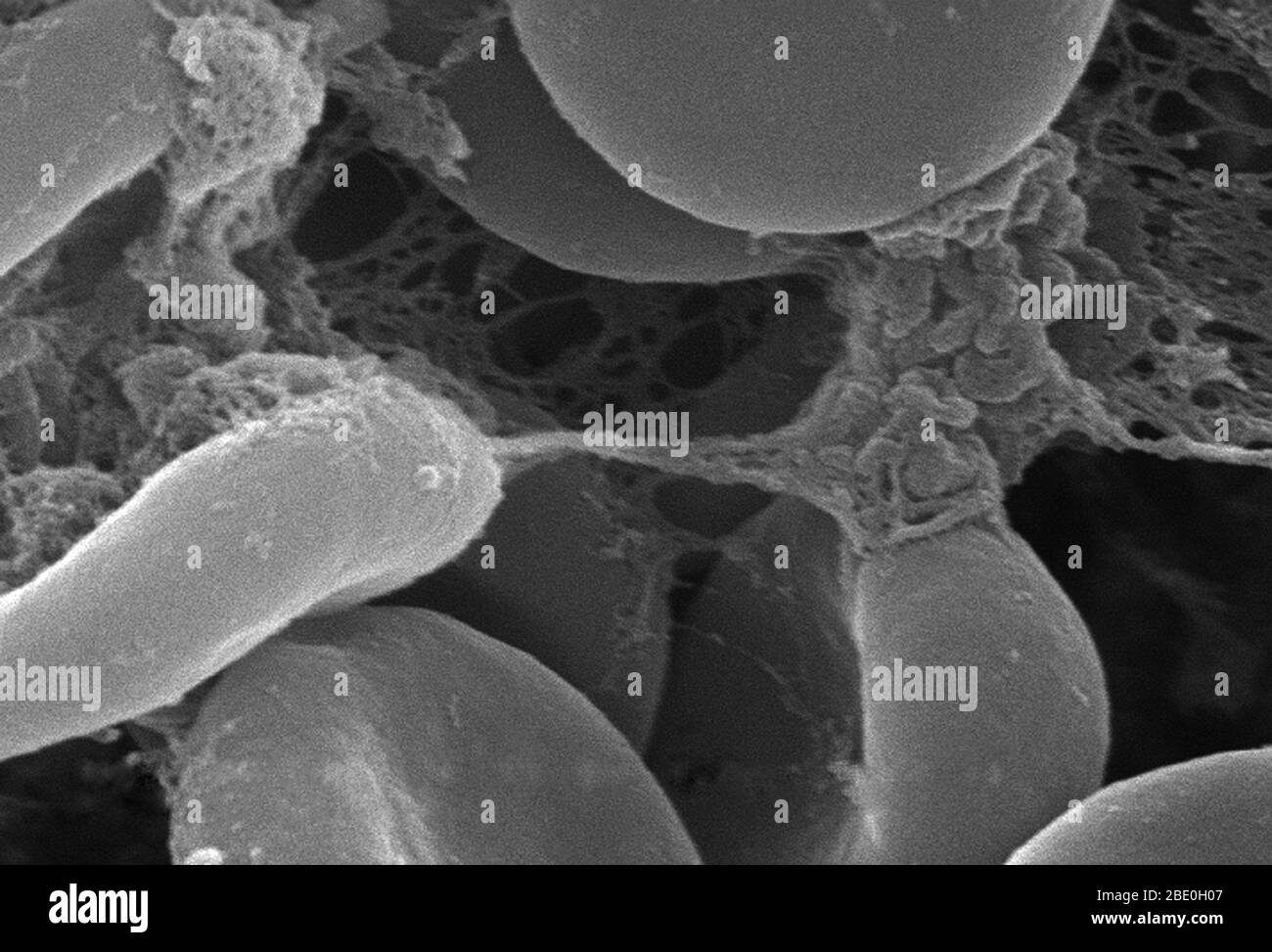 Dieser stark vergrößerte Rasterelektronenmikrograph (SEM) zeigte einen genaueren Blick auf die Details, die von der Anzahl der roten Blutkörperchen gezeigt wurden, die in einer faserartigen Matrix auf der luminalen Oberfläche eines innewohnenden Gefässes verstrickt waren; 11379x vergrößert. In diesem Fall war der Innewelling-Katheter ein Schlauch, der an Ort und Stelle gelassen wurde und ein Patentportal direkt in ein Blutgefäß schuf. Beachten Sie die zytomorphologische Form der einzelnen Erythrozyten, die die Oberfläche dieser Hämoglobin-gefüllten Zellen erhöht, wodurch ein höheres Maß an Gasaustausch, die ihre primäre Funktion in einem in vivo ist gefördert Stockfoto