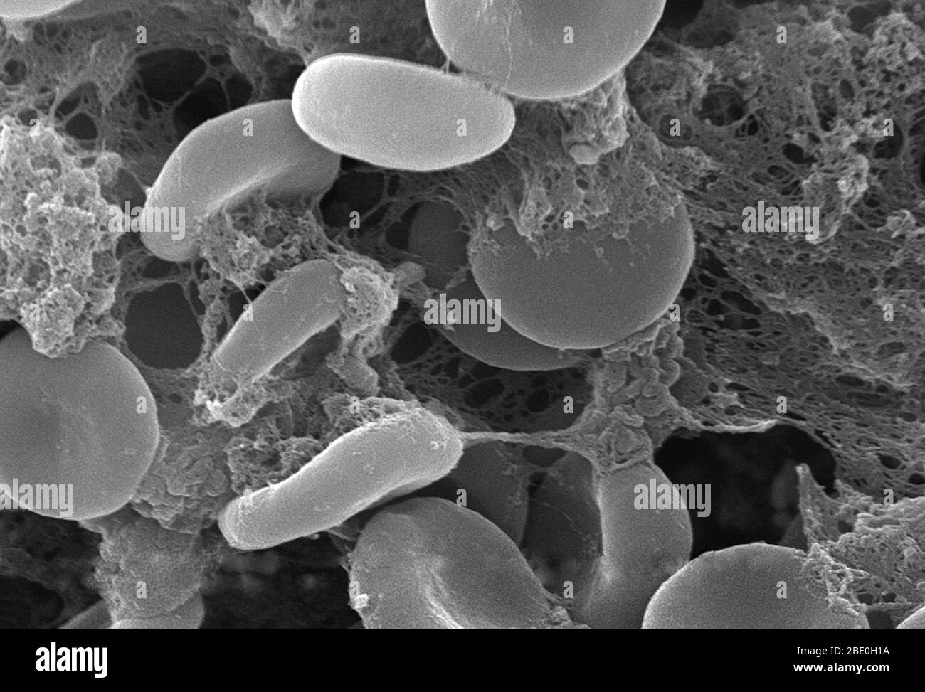 Dieser Rasterelektronenmikrograph (SEM) zeigte eine genauere Ansicht der Anzahl roter Blutkörperchen, die in einer faserartigen Matrix auf der luminalen Oberfläche eines innewohnenden Gefässes verstrickt waren; vergrößert 5698x. In diesem Fall war der Innewelling-Katheter ein Schlauch, der an Ort und Stelle gelassen wurde und ein Patentportal direkt in ein Blutgefäß schuf. Beachten Sie die zytomorphologische Form jeder Erythrozyte, die die Oberfläche dieser Hämoglobin-gefüllten Zellen erhöht, wodurch ein größeres Maß an Gasaustausch, die ihre primäre Funktion in einer in vivo-Einstellung ist gefördert. In ihrer adulten Phase, diese Zellen po Stockfoto