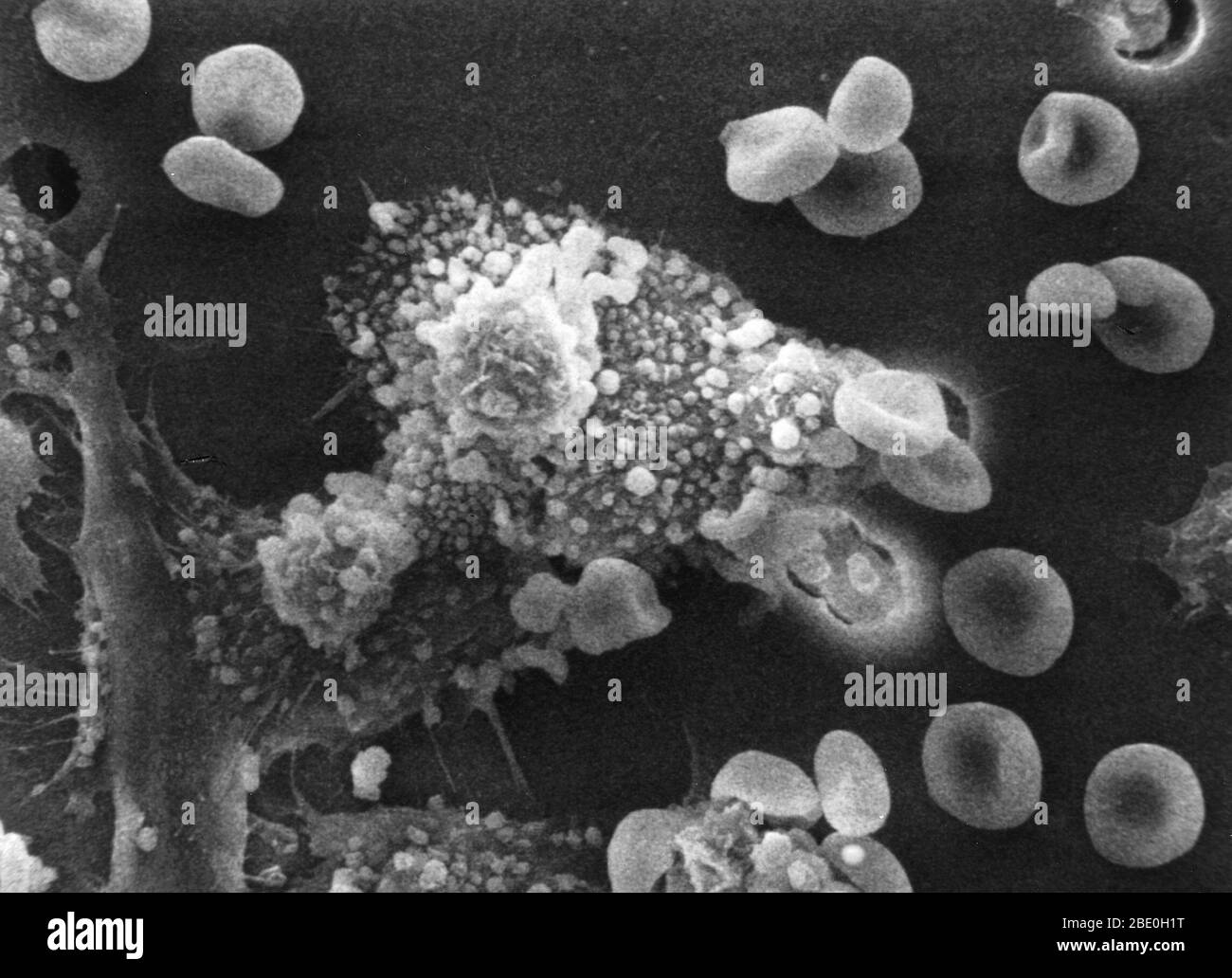 Schritt drei einer sechs-Schritte-Sequenz des Todes einer Krebszelle. Makrophagen beginnen, mit der Krebszelle zu verschmelzen und ihre Giftstoffe in sie einzuspritzen. Die Zelle beginnt zu runden und verliert ihre Spitzen. Fotovergrößerung: 8000x Stockfoto