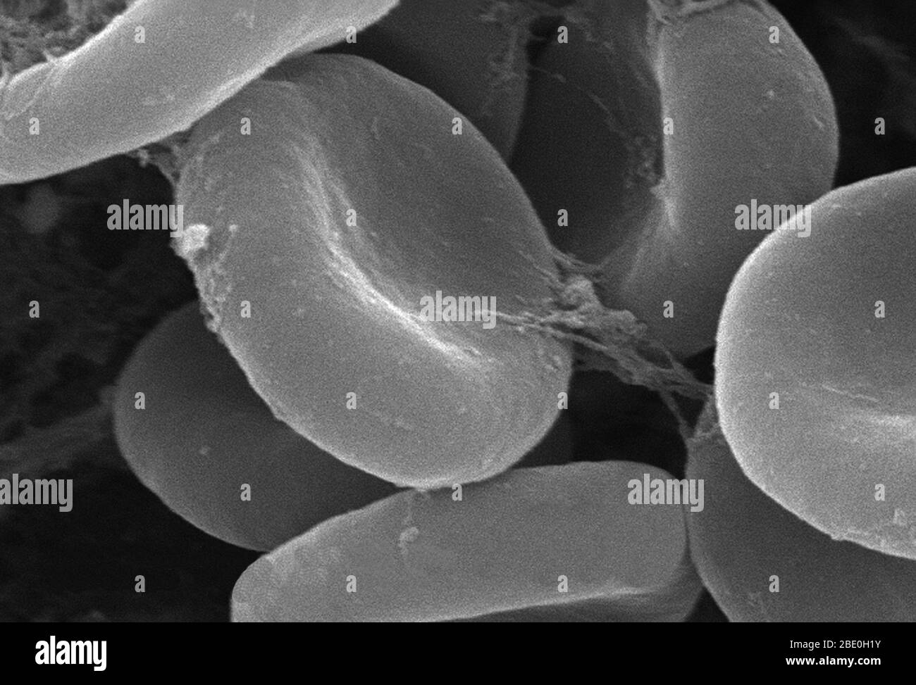 Dieser stark vergrößerte Rasterelektronenmikrograph (SEM) zeigte einen genaueren Blick auf die Details, die von der Anzahl der roten Blutkörperchen gezeigt wurden, die in einer faserartigen Matrix auf der luminalen Oberfläche eines innewohnenden Gefässes verstrickt waren; 11379x vergrößert. In diesem Fall war der Innewelling-Katheter ein Schlauch, der an Ort und Stelle gelassen wurde und ein Patentportal direkt in ein Blutgefäß schuf. Beachten Sie die zytomorphologische Form der einzelnen Erythrozyten, die die Oberfläche dieser Hämoglobin-gefüllten Zellen erhöht, wodurch ein höheres Maß an Gasaustausch, die ihre primäre Funktion in einem in vivo ist gefördert Stockfoto