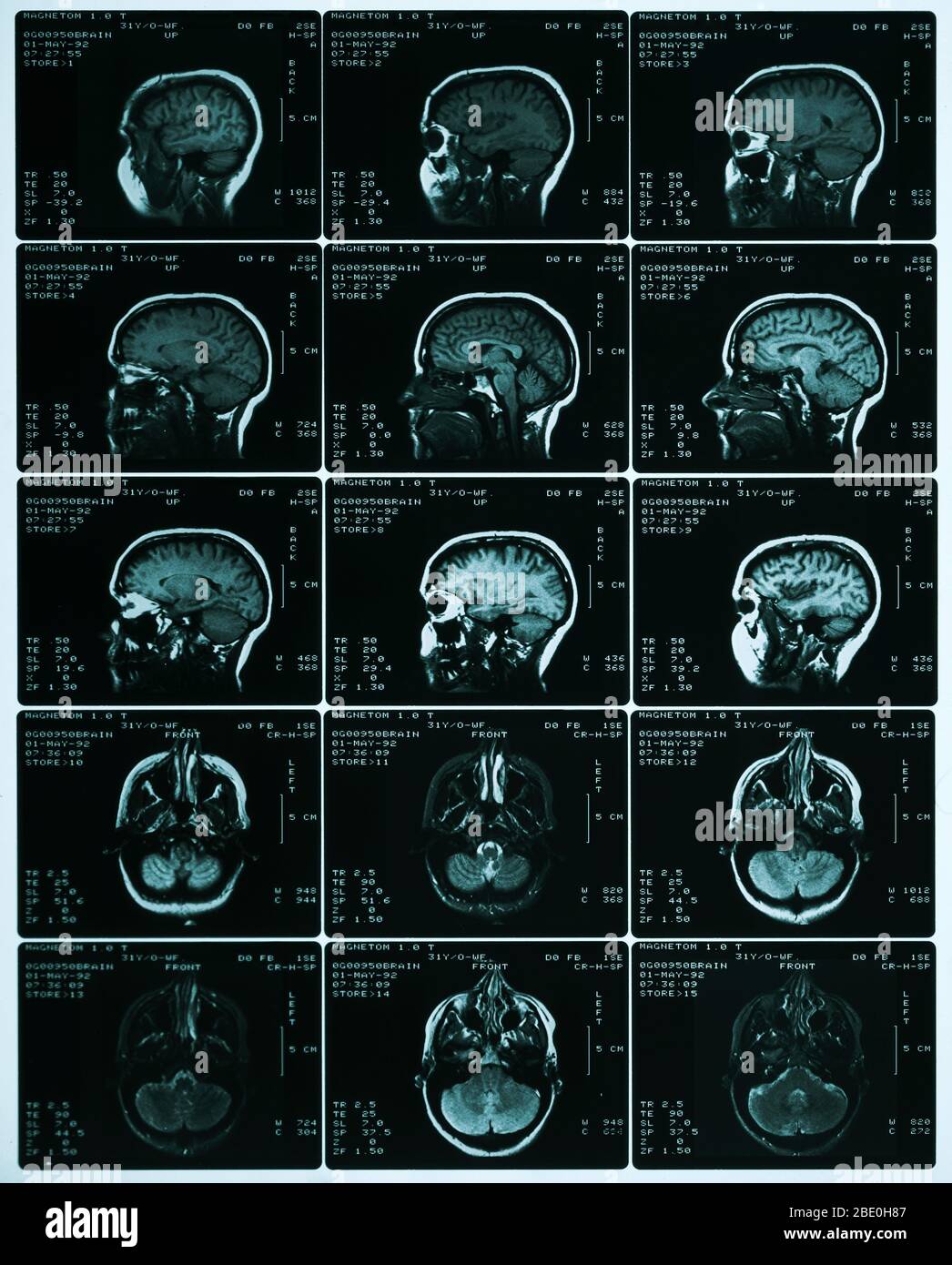 Ein Blatt mit MRT-Scans, die die normale Anatomie des Gehirns zeigen. Auffällig sind die Großhirnrinde, der Corpus callosum, der Thalamus, die Medulla oblongata, das Kleinhirn und der Hirnstamm. Stockfoto