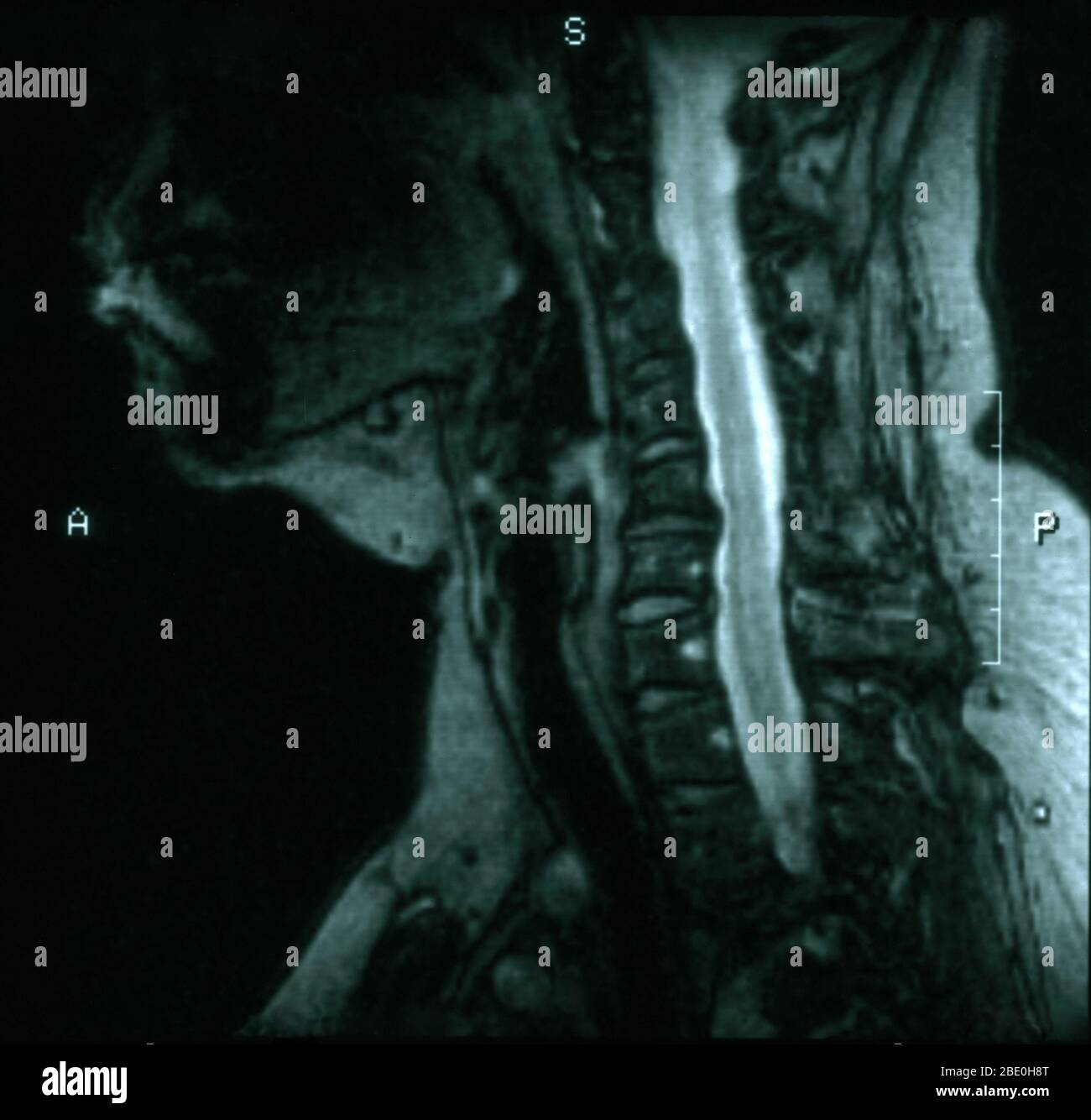 MRT der Halswirbelsäule vom kraniovertebralen Übergang bis zur Höhe T3-T4. Die MRT-Schichtdicke beträgt 5,0 MM. Die MRT zeigt degenerative Bandscheibenerkrankungen bei C5-6 und C6-7 mit posterioren Osteophyten auf beiden Ebenen, die eine leichte Verengung des Wirbelkanals, insbesondere bei C5-6, verursachen. Stockfoto
