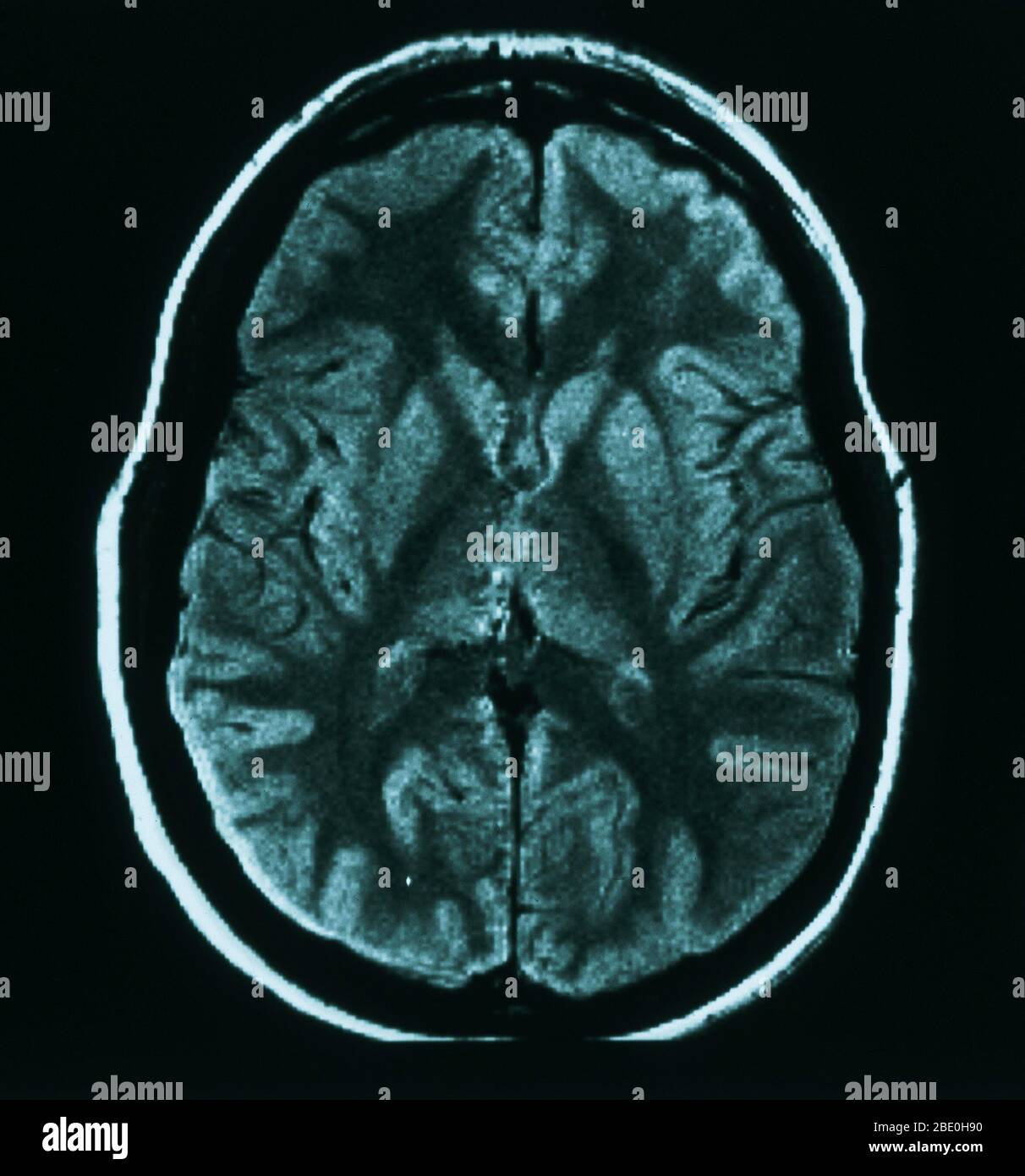 MRT-Untersuchung (axiale Ansicht) durch das Gehirn eines 31-jährigen Weibchens. Die MRT ist normal. Stockfoto
