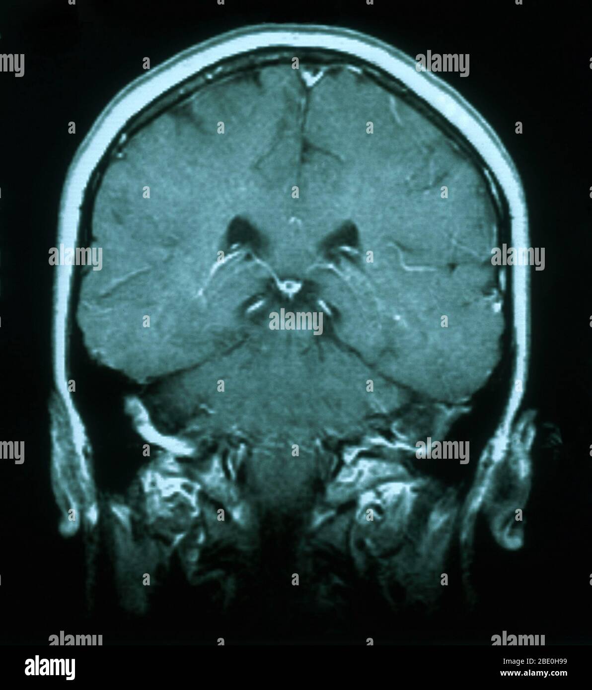 MRT-Untersuchung, T1-gewichtete, axiale Ansicht durch das Gehirn einer 54-jährigen Frau. Die MRT ist normal. Stockfoto