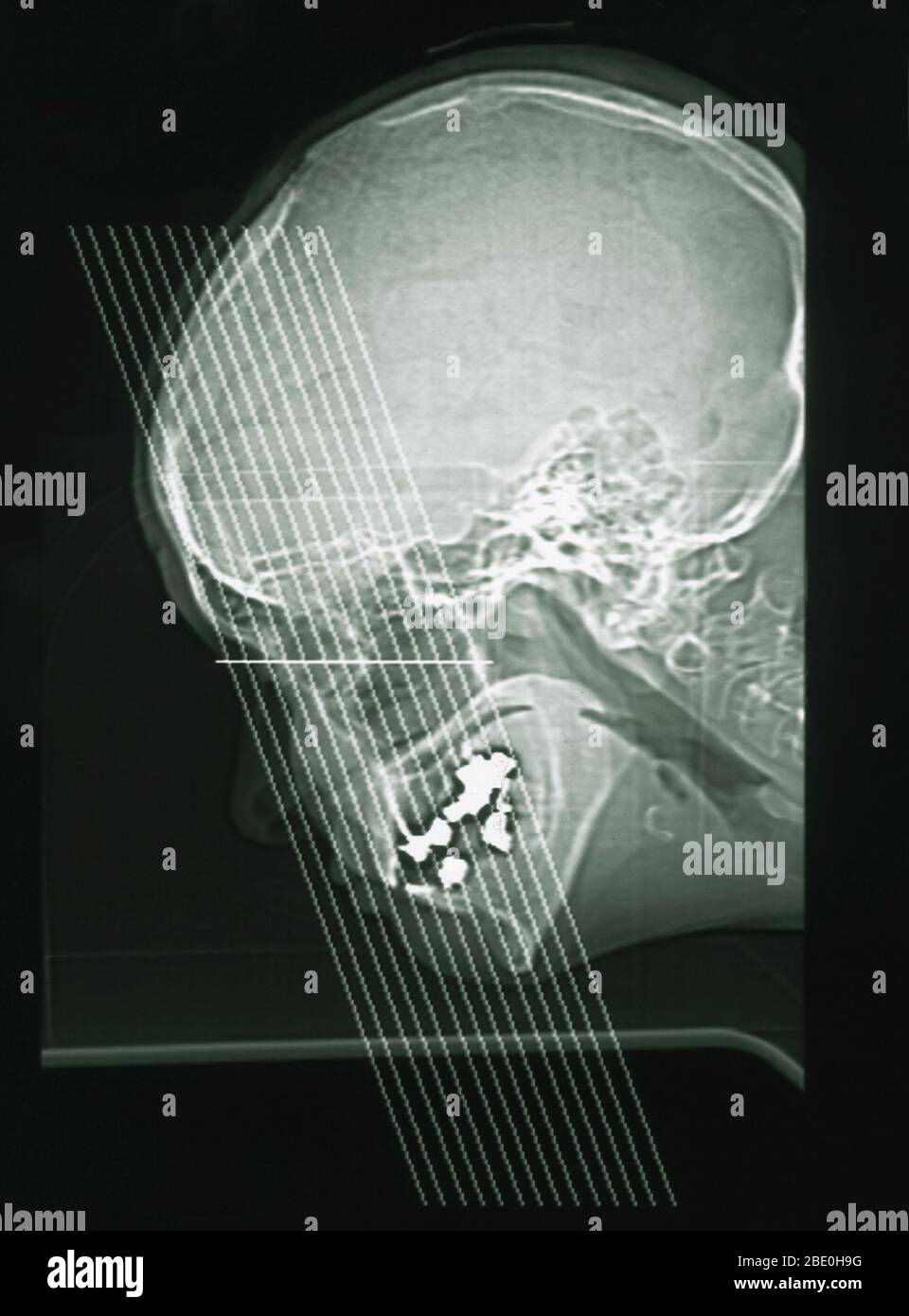 MRT zeigt die Nebenhöhlen einer 54-jährigen Frau. Die MRT ist normal. Stockfoto