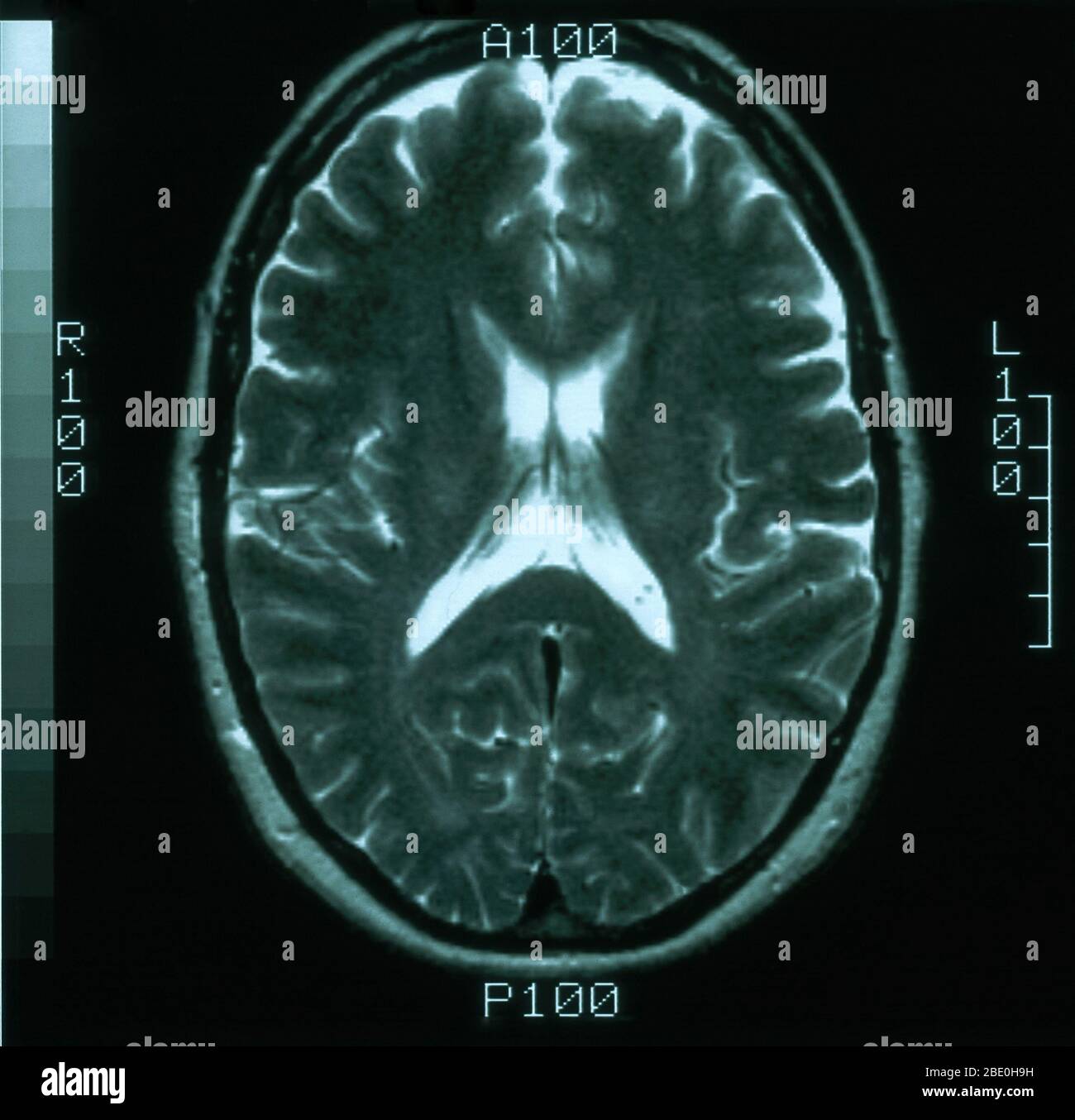 MRT-Scan, T2-gewichtete, axiale Ansicht durch das Gehirn eines 54-jährigen Weibchens. Die MRT ist normal. Stockfoto