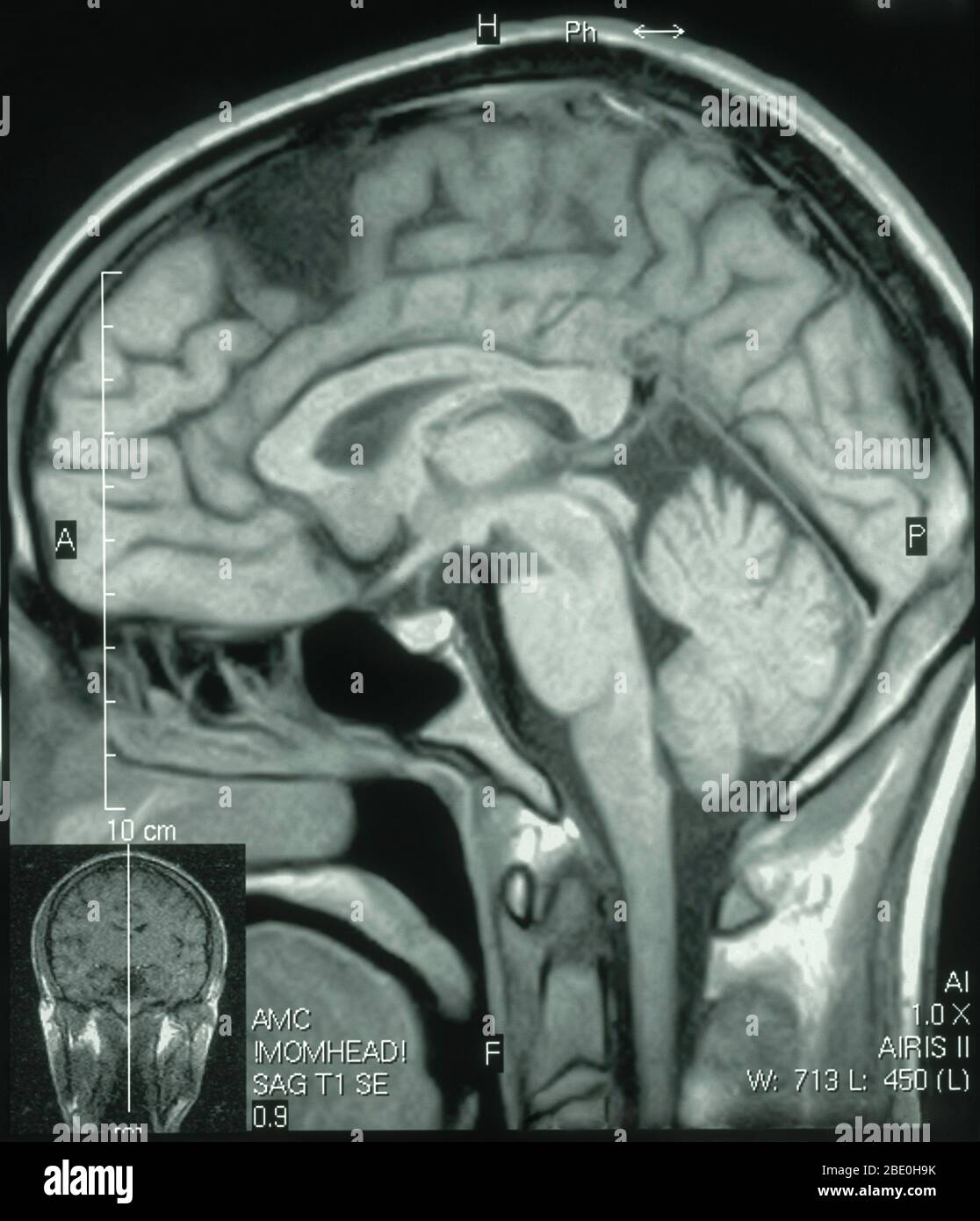 MRT des Gehirns (sagittale Ansicht) eines 26-jährigen Mannes. Die MRT wurde als Folge einer Kopfverletzung bei einem Autounfall aufgenommen. Die Diagnose der MRT-Untersuchungen ist eine kleine Arachnoidzyste im parasagittalen vorderen linken frontalen Bereich. Alle anderen Aspekte erscheinen normal. Stockfoto