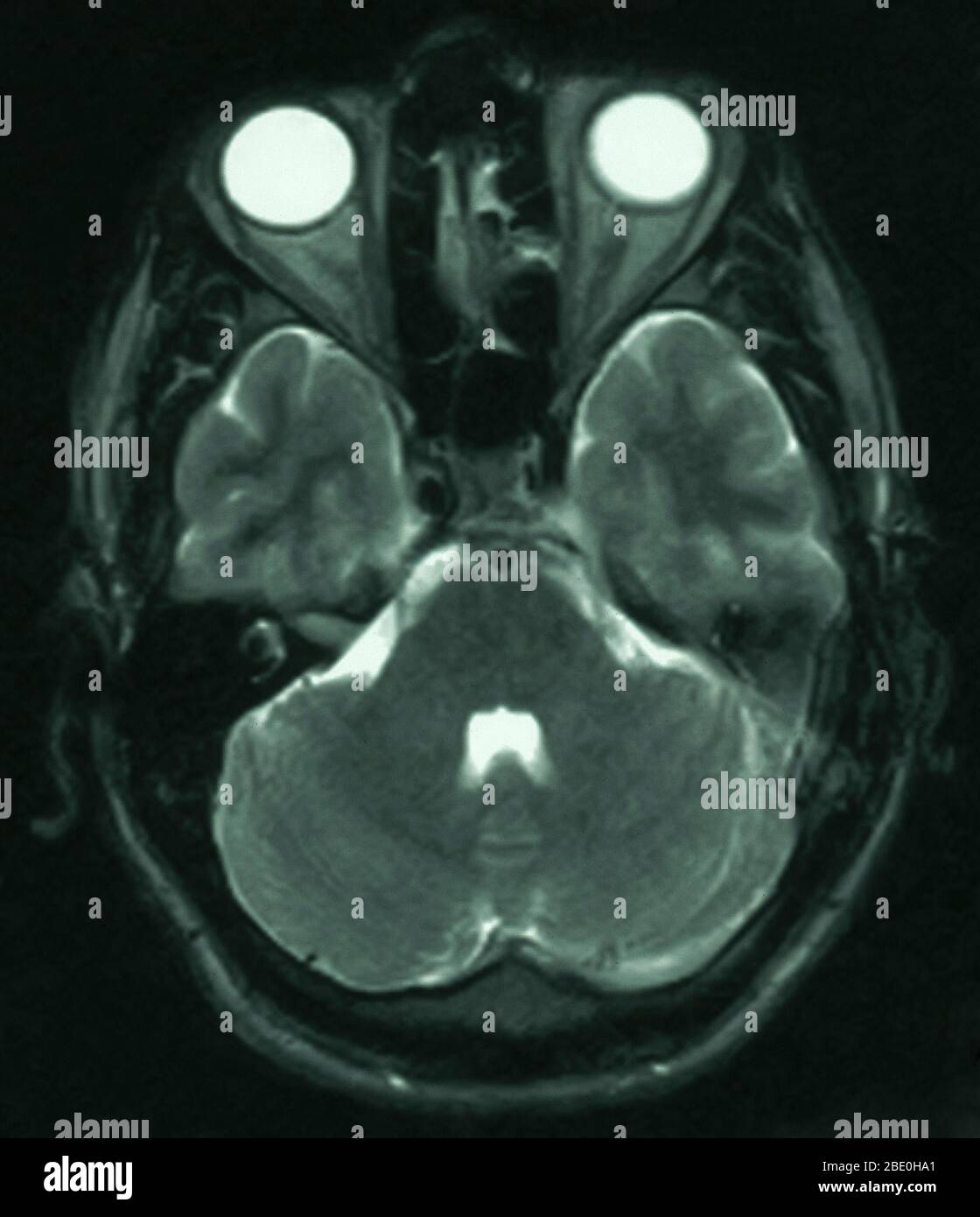 MRT des Gehirns (axiale Ansicht) eines 26-jährigen Mannes. Die MRT wurde als Folge einer Kopfverletzung bei einem Autounfall aufgenommen. Die Diagnose der MRT-Untersuchungen ist eine kleine Arachnoidzyste im parasagittalen vorderen linken frontalen Bereich. Die Zyste ist in dieser Ansicht nicht zu sehen, da sie unterhalb der betroffenen Region liegt. Alle anderen Aspekte erscheinen normal. Stockfoto