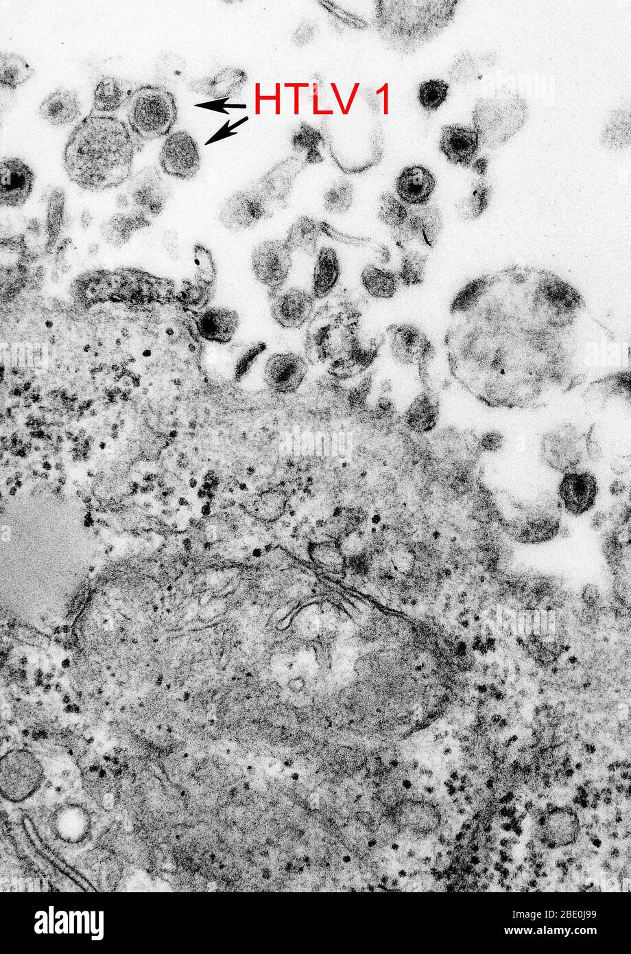 Das humane T-Zell-Leukämie-Virus Typ 1 (HTLV-1), (auch bekannt als das humane T lymphotrope Virus Typ 1), das humane T-Zell-Leukämie-Virus Typ 1 (HTLV-1), ein humanes Onkoretrovirus, ist der ätiologische Wirkstoff der erwachsenen T-Zell-Leukämie und der tropischen spastischen Paraparese/HTLV-1-assoziierten Myelopathie. Stockfoto