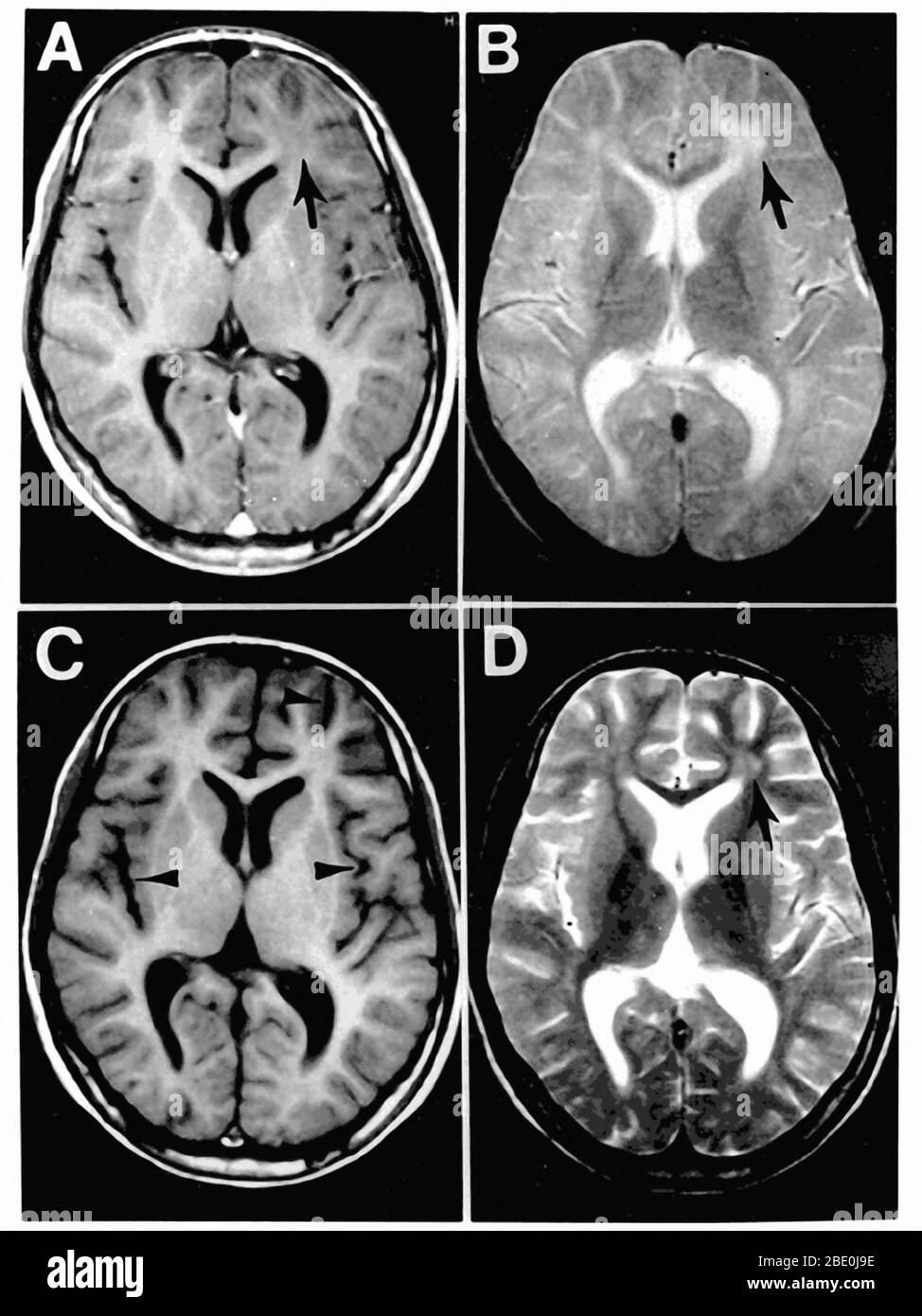 Subakute sklerosierende Panenzephalitis (KOMPLIKATION der Maserninfektion). Abbildung 1. MRT-Aufnahmen des Gehirns zum Zeitpunkt der Präsentation in der neurologischen Klinik (A und B) und 3 Monate später (C und D). Die Felder A und C sind T1-gewichtete Bilder, B und D T2-gewichtete Bilder. Die erste MRT-Untersuchung (A und B) zeigt eine fokale Anomalie in der subkortikalen weißen Substanz des linken Frontallappen, bestehend aus einem hypointenten Signal auf dem T1-gewichteten Bild (Pfeil in A) und einem hyperintensiven Signal auf dem T2-gewichteten Bild (Pfeil in B). Bei der Nachuntersuchung ist die fokale Anomalie im linken Frontallappen l Stockfoto