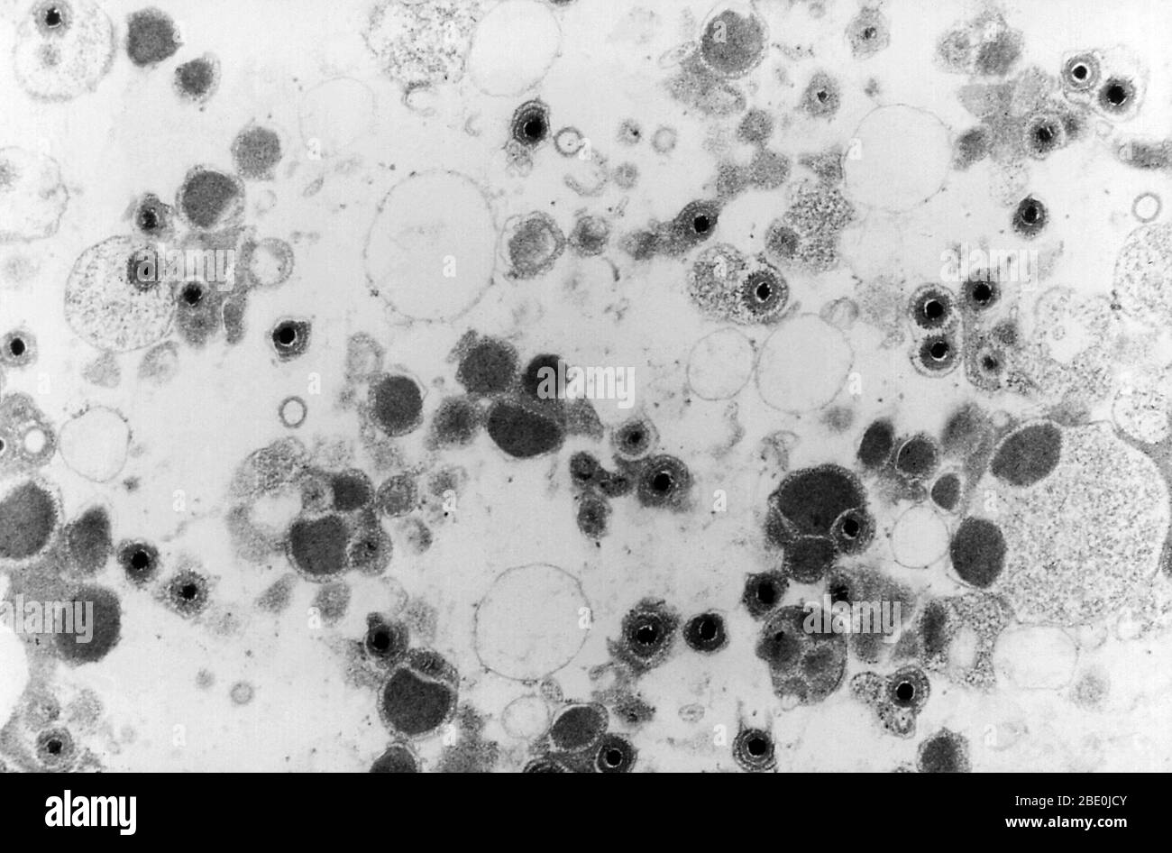 Transmission Electron Micrograph (TEM) zeigt eine Reihe von Cytomegalievirus-Virionen, die in einer unbekannten Gewebeprobe vorhanden sind. Cytomegalievirus (CMV) ist eine Gattung von Viren in der Reihenfolge Herpesvirales, in der Familie Herpesviridae, in der Unterfamilie Betaherpesvirinae. Menschen und Affen dienen als natürliche Wirte. Cytomegalievirus ist ein doppelsträngiger DNA-Virus (dsDNA). Derzeit gibt es acht Arten in dieser Gattung, darunter die Typusart, das menschliche Cytomegalievirus (HCMV, menschliches Herpesvirus 5, HHV-5), die die Spezies ist, die den Menschen infiziert. In der medizinischen Literatur werden die meisten CMV-Erwähnungen ohne weitere Spezifikationsspezifikation erwähnt Stockfoto